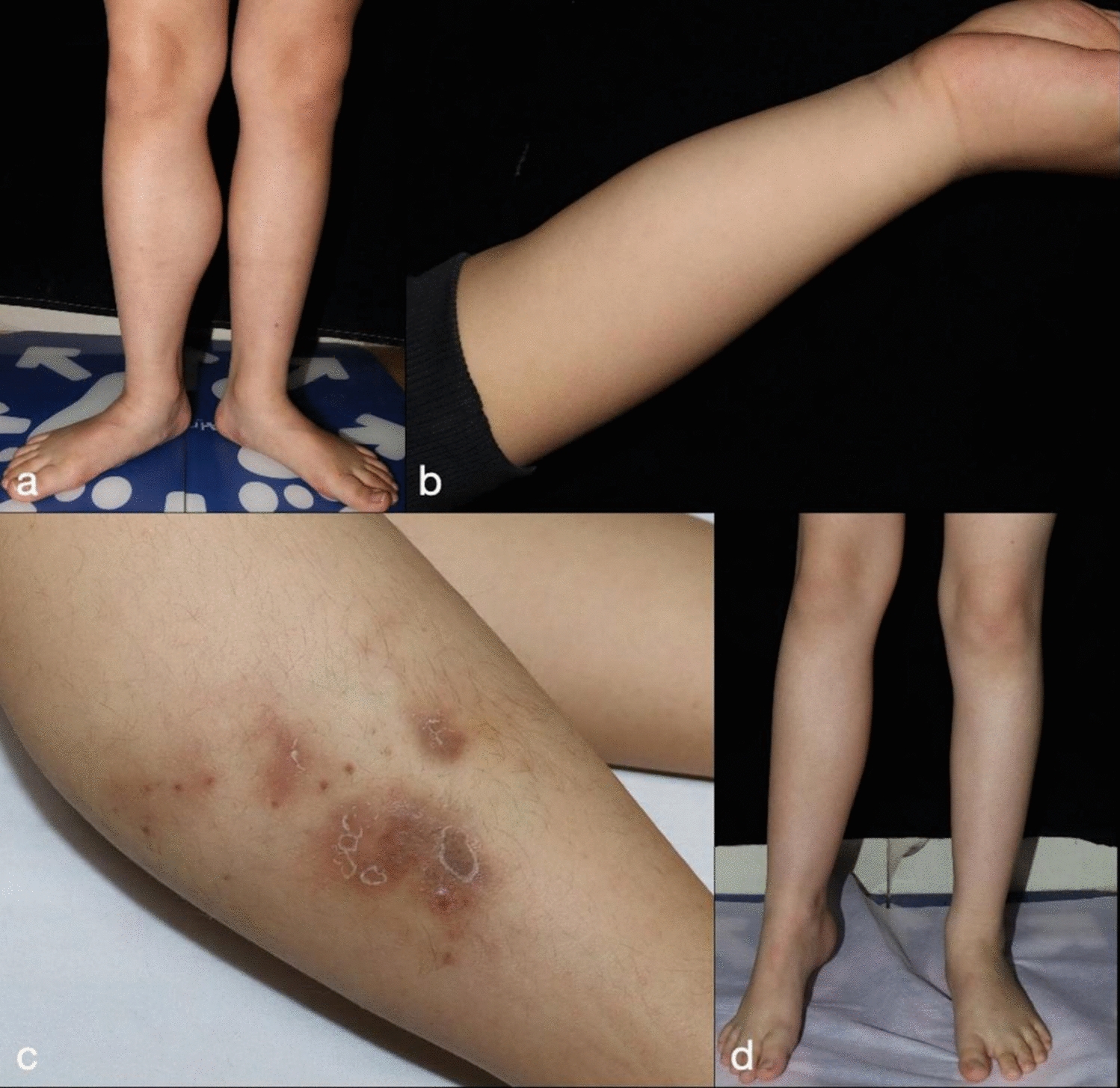 Diagnosis and Oral Sirolimus Treatment of Fibro-Adipose Vascular Anomaly in Pediatric Patients: A Case Series and Comprehensive Review