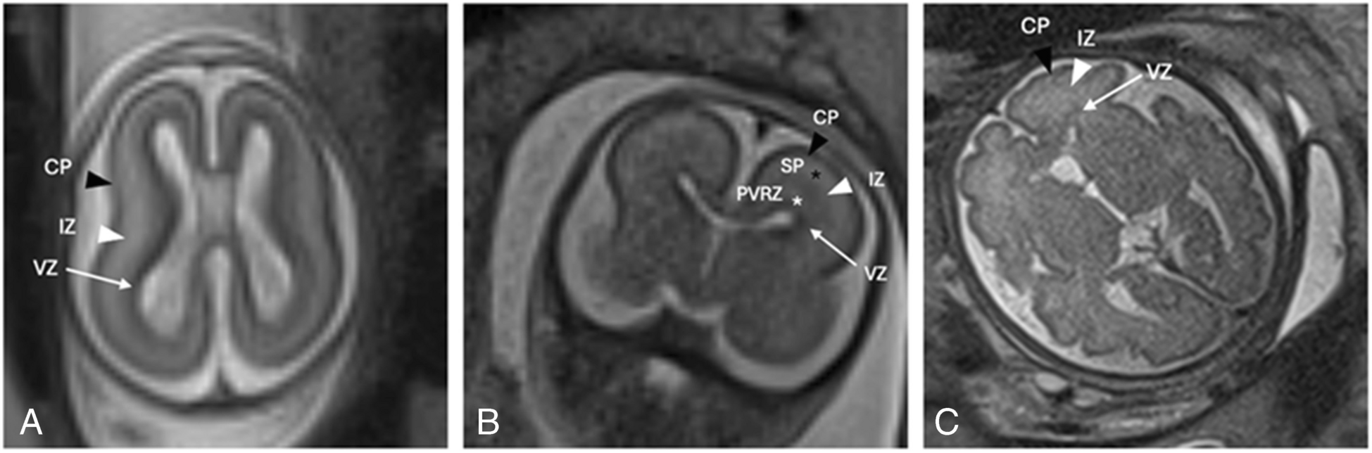 Fundamentals of fetal brain MRI: indications, technique, and normal anatomy