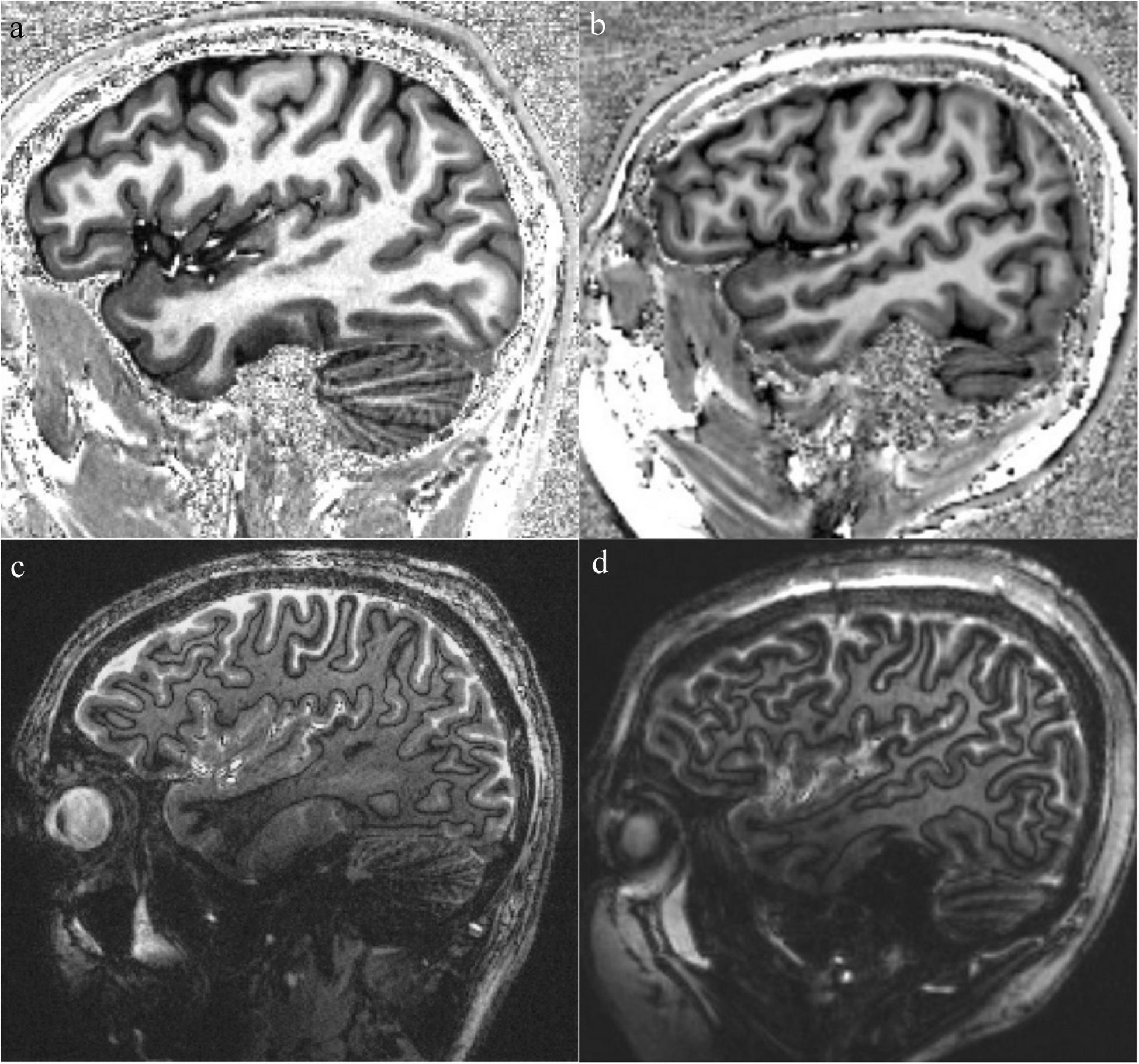 A closer look: pediatric neuroimaging at 7T