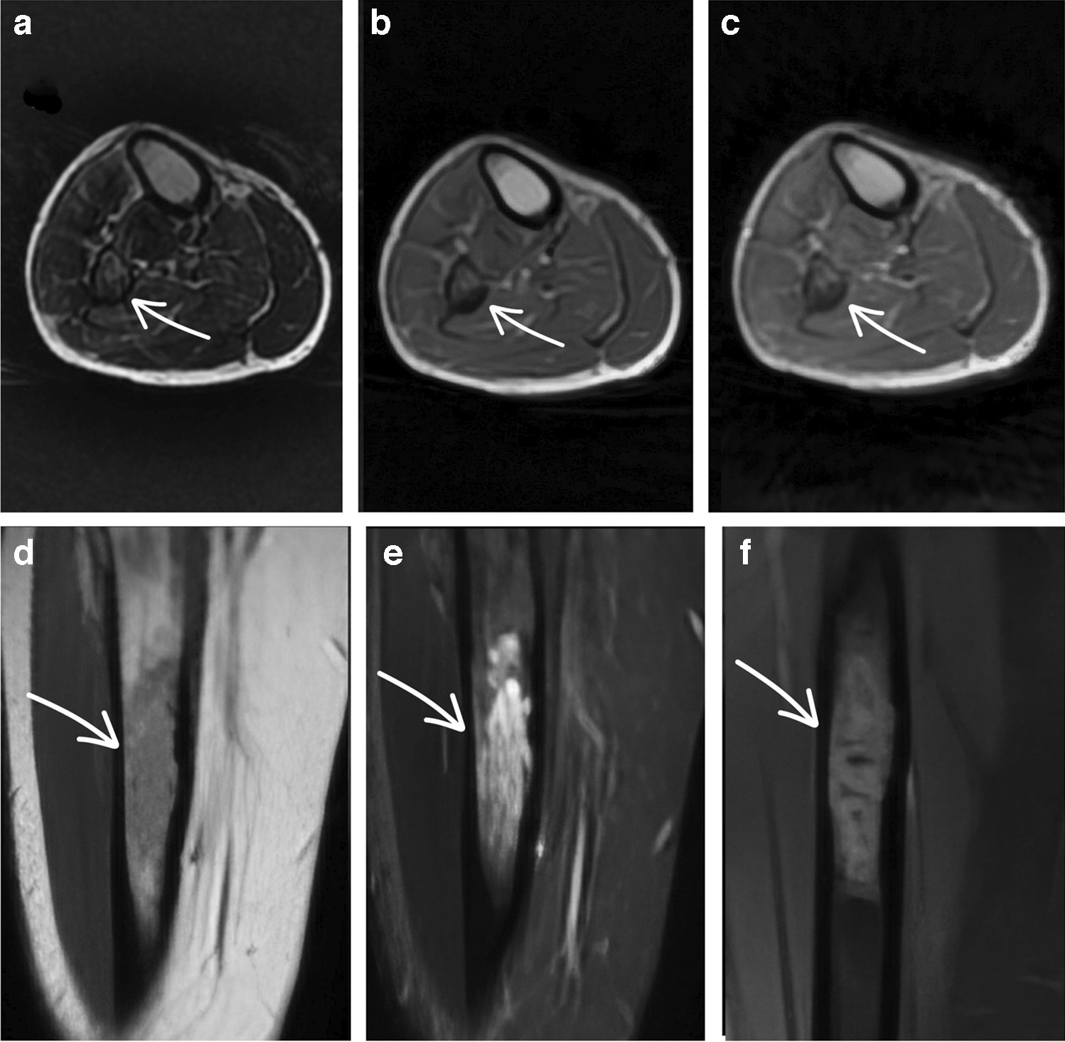 A rare case of calcified metastasis in a patient with primary osseous Ewing’s sarcoma