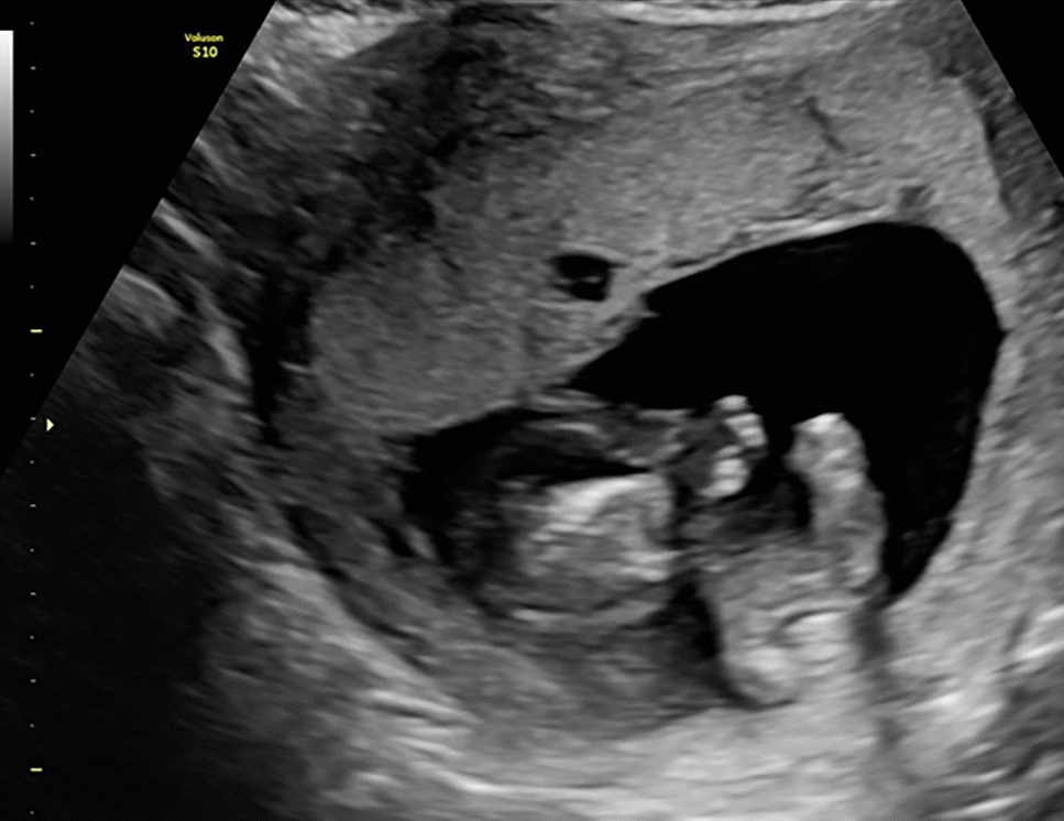 TRAP Sequence Clinical Case: Is a Single Umbilical Artery a Protective Ultrasound Marker for Fetal Heart Failure Development