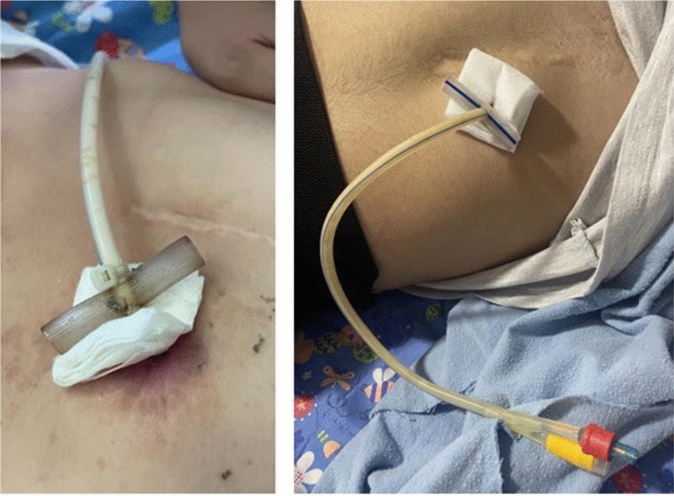 A low-cost pediatric gastrostomy securement system for resource-limited settings: a preliminary observational study