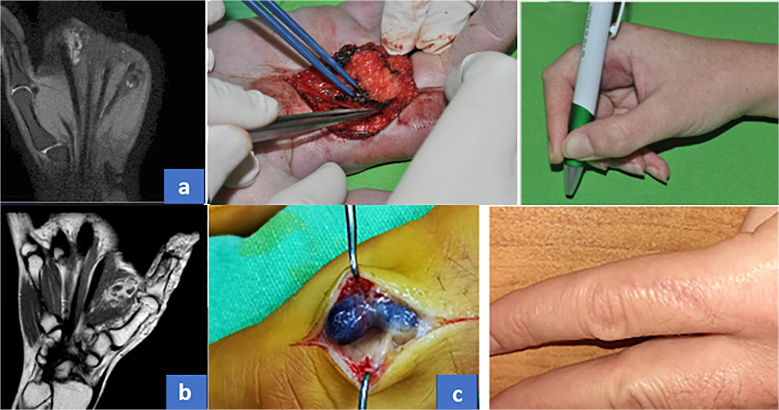 Papillary Endothelial Hyperplasia (Masson Tumor) of the Hand. Surgical and Pathological Consideration from Seven Cases Using New Vascular Markers