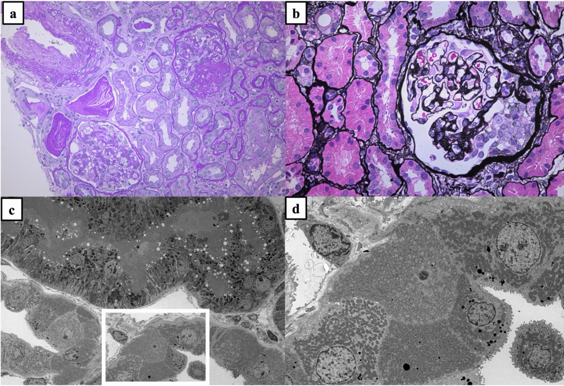 Taurine supplementation improves physical activity level in a hemodialysis patient with mitochondrial disease: a case report
