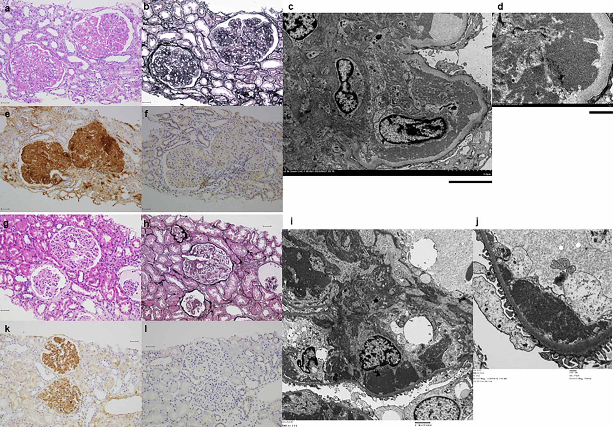 Clinicopathological features of familial fibronectin glomerulopathy caused by a splice site variant in the Fibronectin 1 gene: a case report
