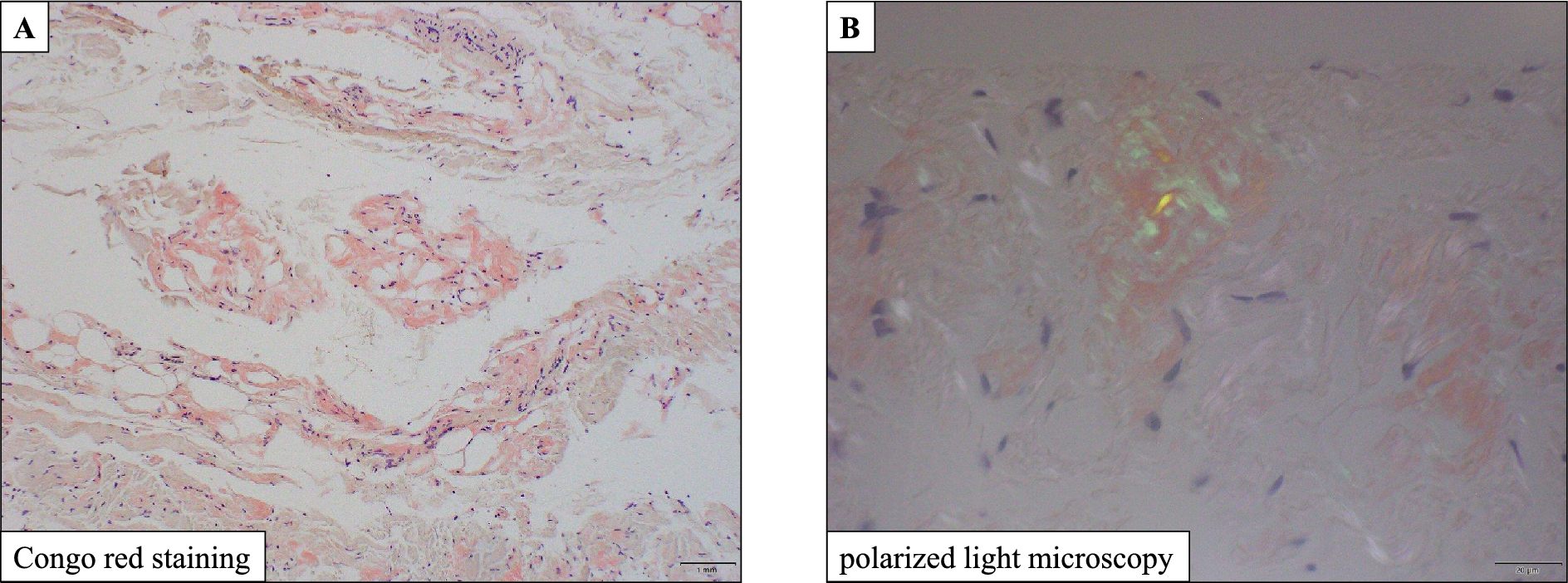 Systemic AA amyloidosis with amyloid deposition in the peritoneum at the time of initiating peritoneal dialysis