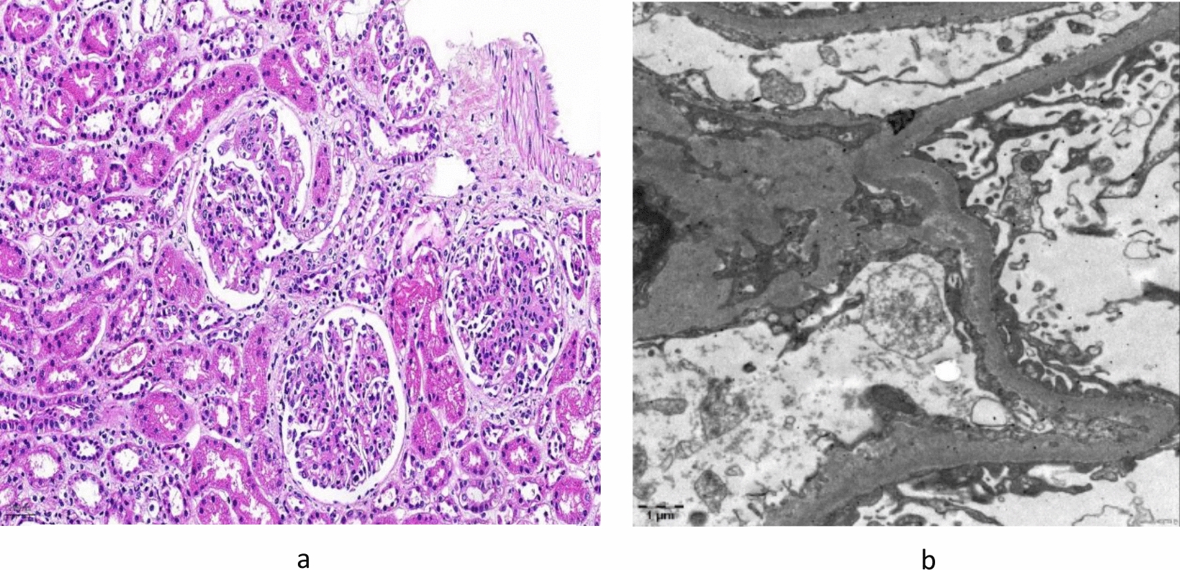 Successful outcome of a refractory IgA vasculitis nephritis in children treated with telitacicept