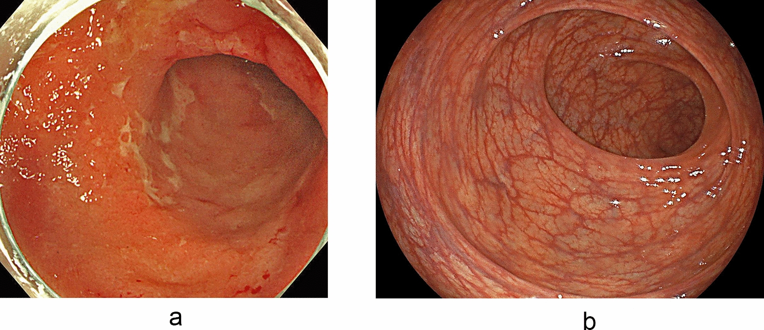 A case of ulcerative colitis in a patient undergoing surgery due to exacerbation resulting in toxic megacolon after SARS-CoV-2 vaccination
