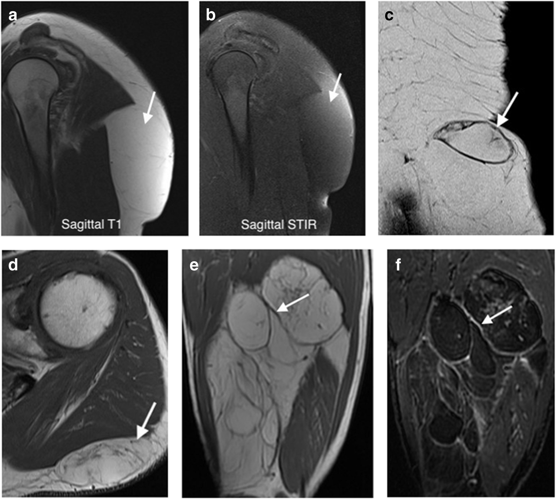 The role of molecular pathology in soft tissue tumor diagnosis: what the radiologist needs to know