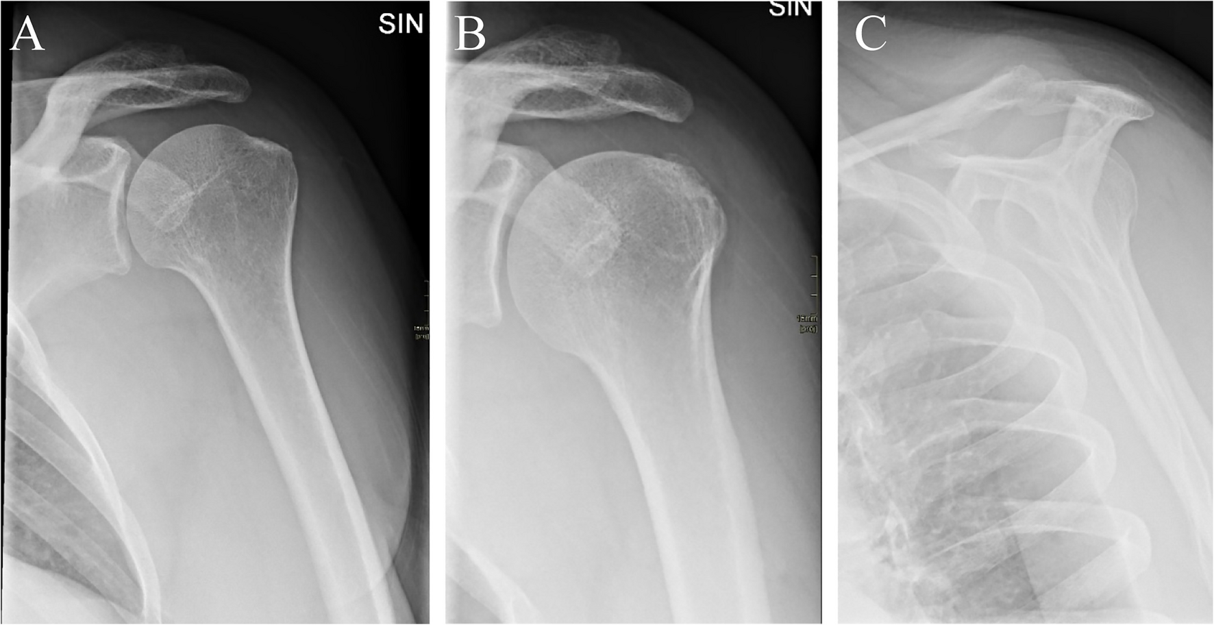 Radiographic findings in patients suspected of subacromial impingement syndrome in relation to shoulder pain and disability