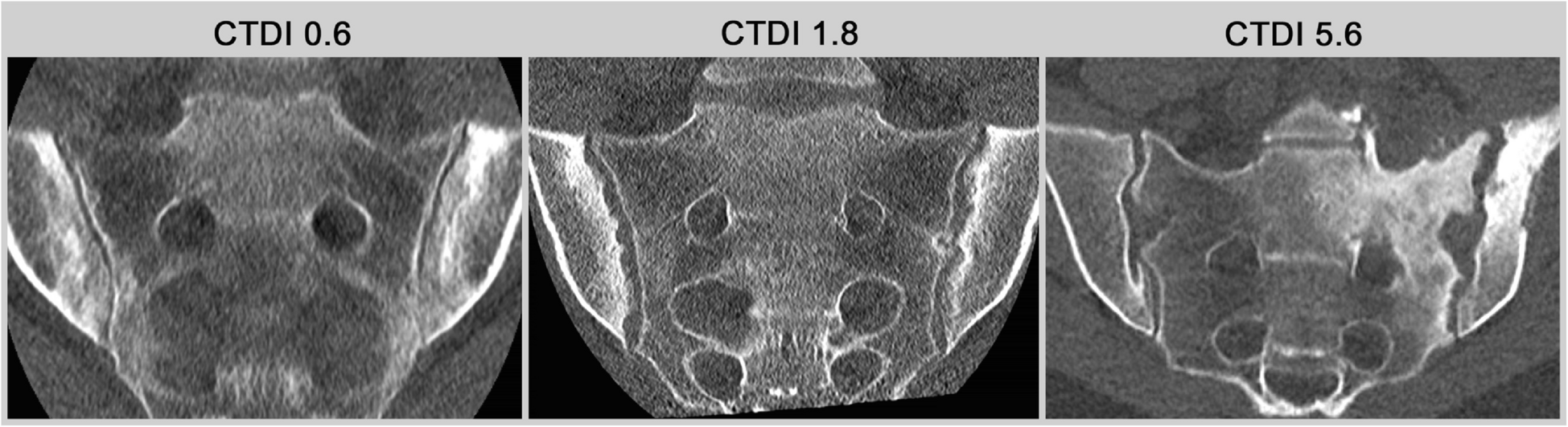Current and future role of CT and advanced CT applications in inflammatory arthritis in the clinic and trials
