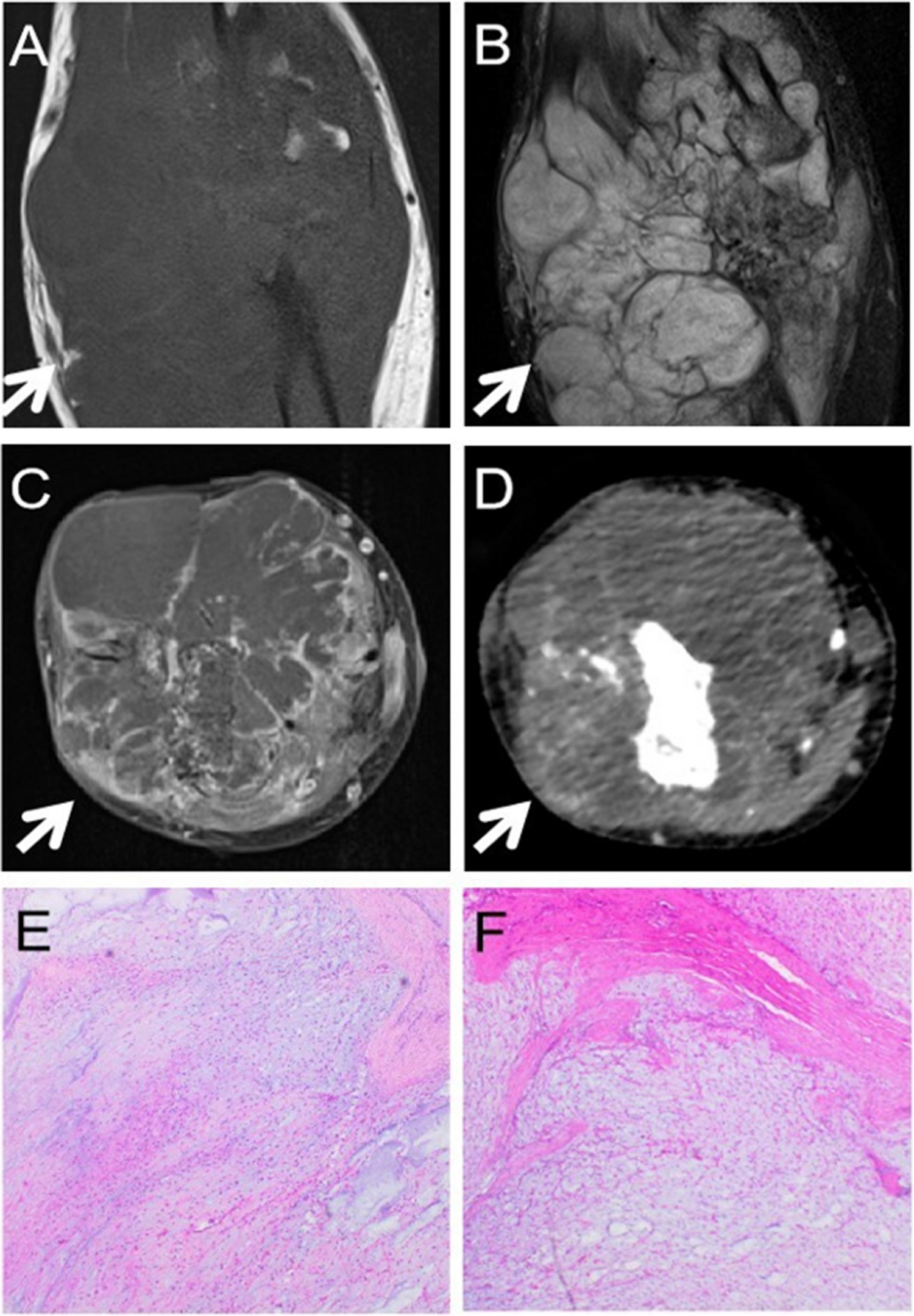 A rare case of atypical ossifying fibromyxoid tumor: multiple recurrences and metastasis