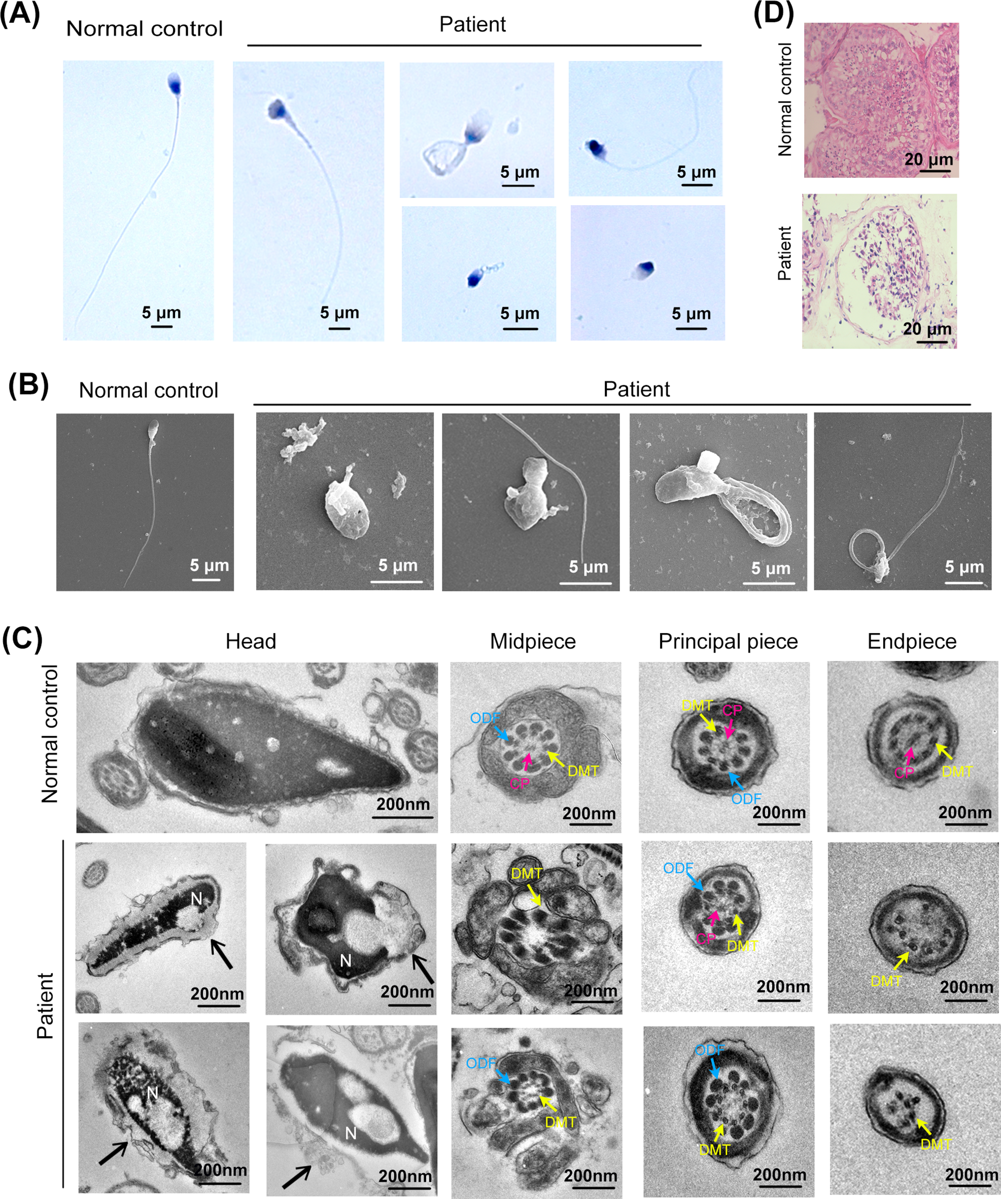 Identification of an  Mutation Associated With Necrozoospermia and Failure of Testi-ICSI