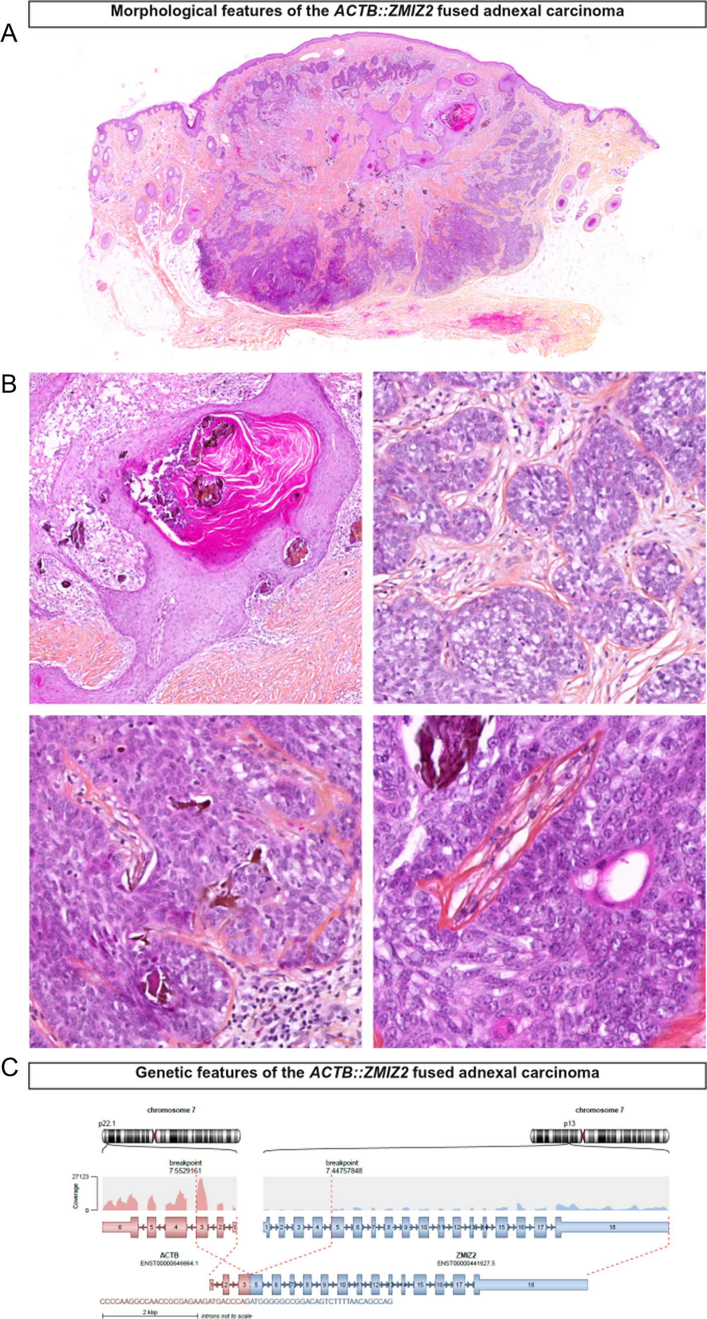 Adnexal carcinoma with  fusion: a third case