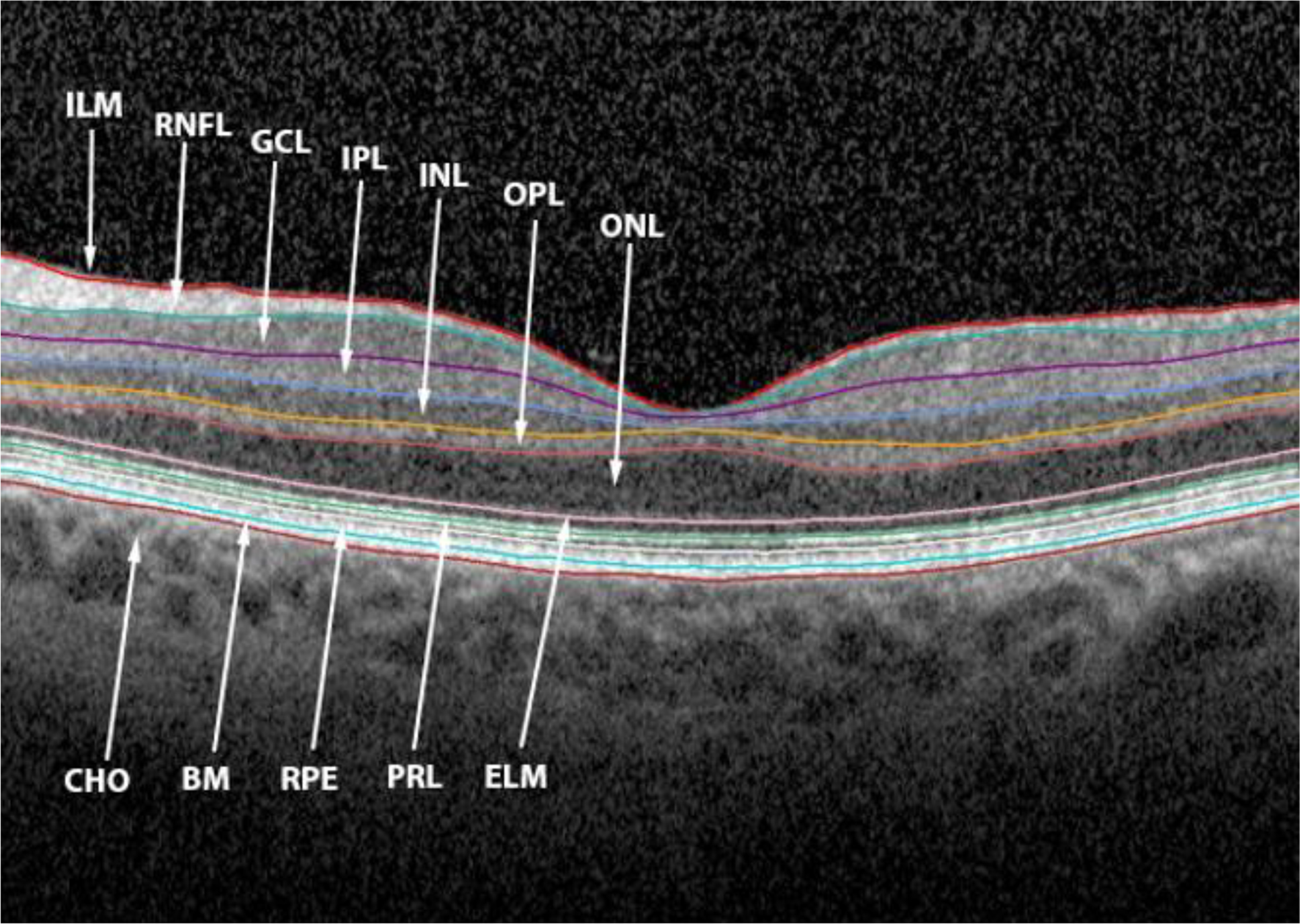 Benefit of continuous positive airway pressure on optic nerve damage in patients with obstructive sleep apnea