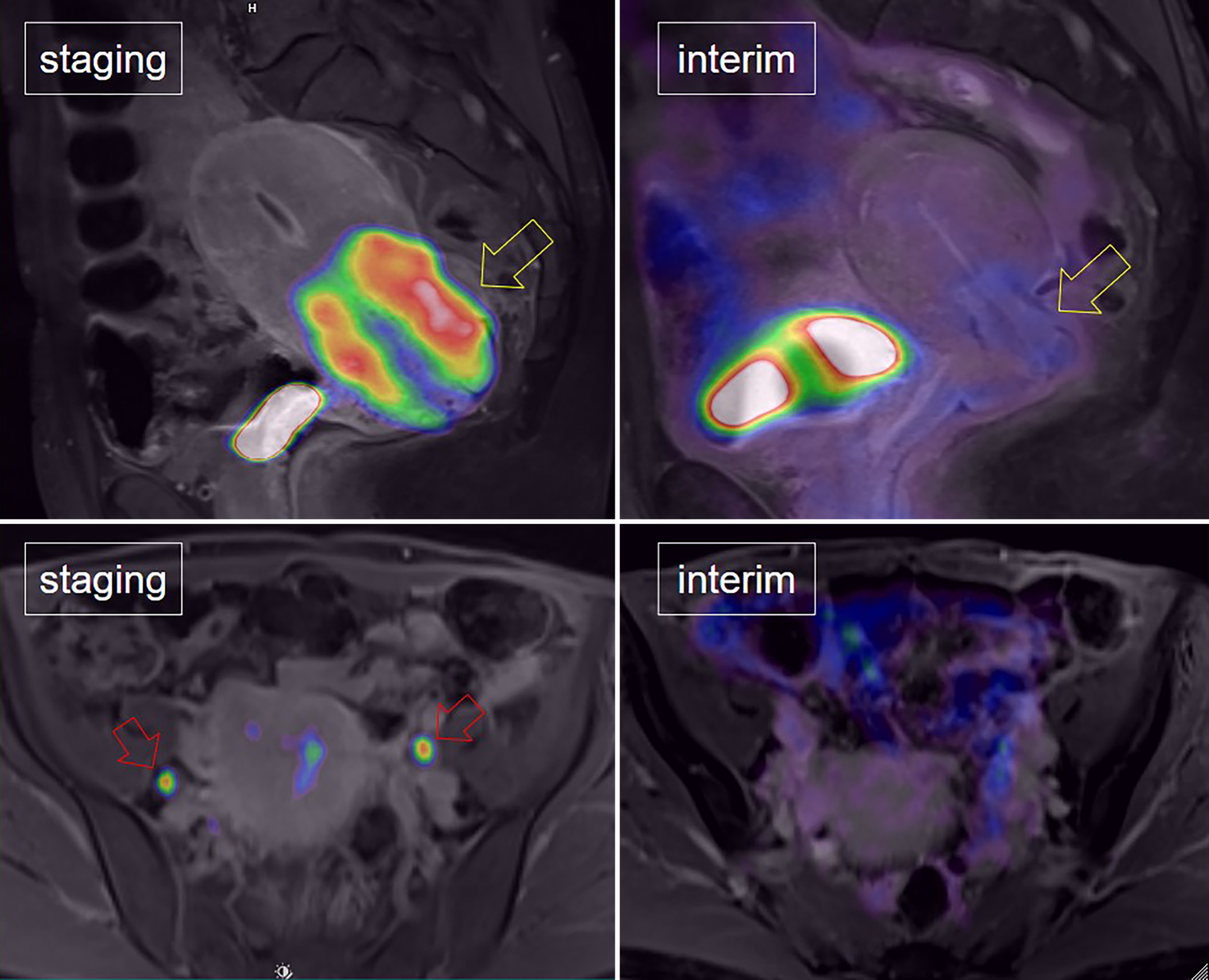 Association of long-term treatment outcomes with changes in PET/MRI characteristics and the type of early treatment response during concurrent radiochemotherapy in patients with locally advanced cervical cancer