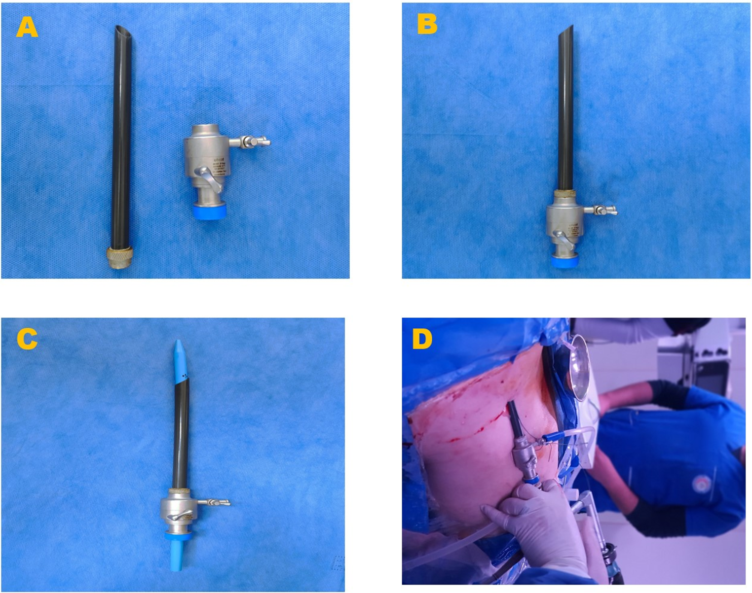 Modified amplatz sheath with suction versus standard sheath in percutaneous nephrolithotomy for treating large renal stones > 2 cm: a prospective randomized trial