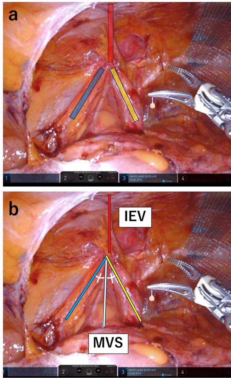 Visual course of anatomical landmarks around the internal inguinal ring as a guide for horizon adjustment in laparoscopic inguinal hernia repair