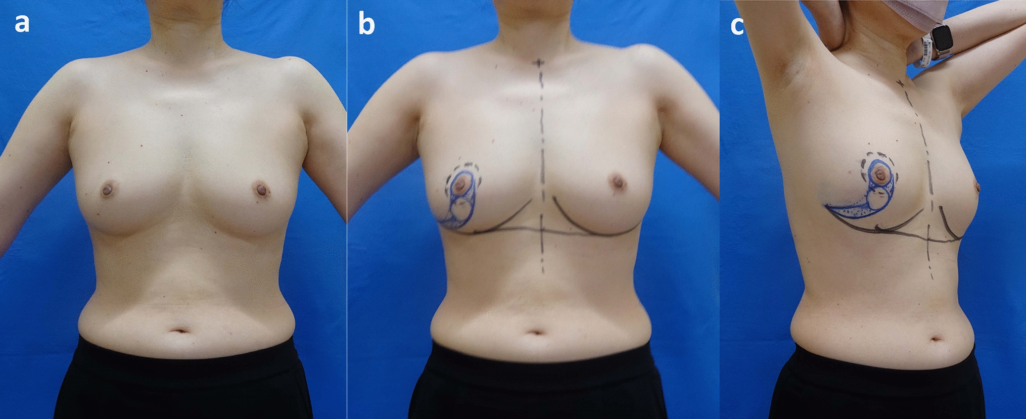 Oncoplastic breast-conserving surgery using a modified Grisotti’s flap for a patient with central breast cancer in a non-ptotic breast