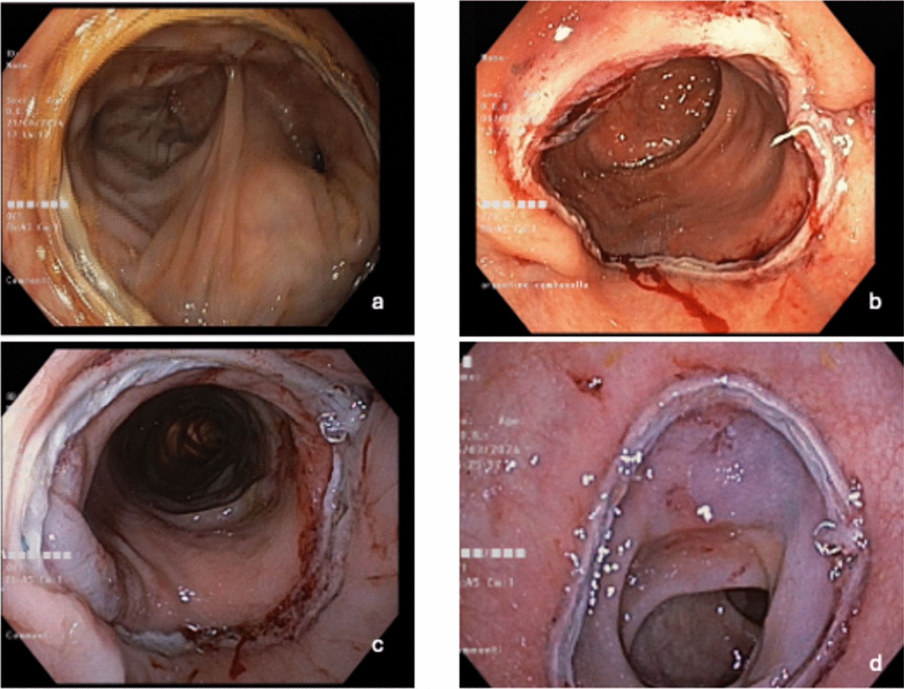 Mitigating ‘inevitable’ anastomotic leaks in left-sided colorectal surgery: a combined strategy using indocyanine green fluorescence, intraoperative colonscopy and patient risk profiling