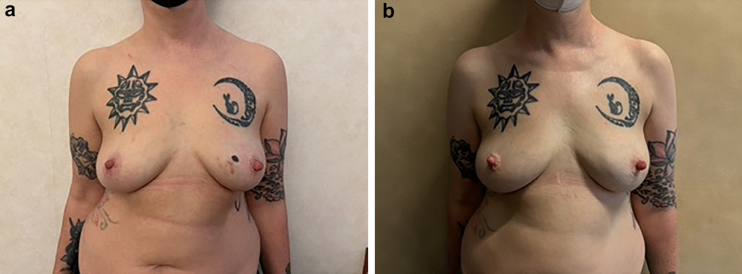 Volume replacement procedure adopting biomaterial: early considerations from a multicentric study