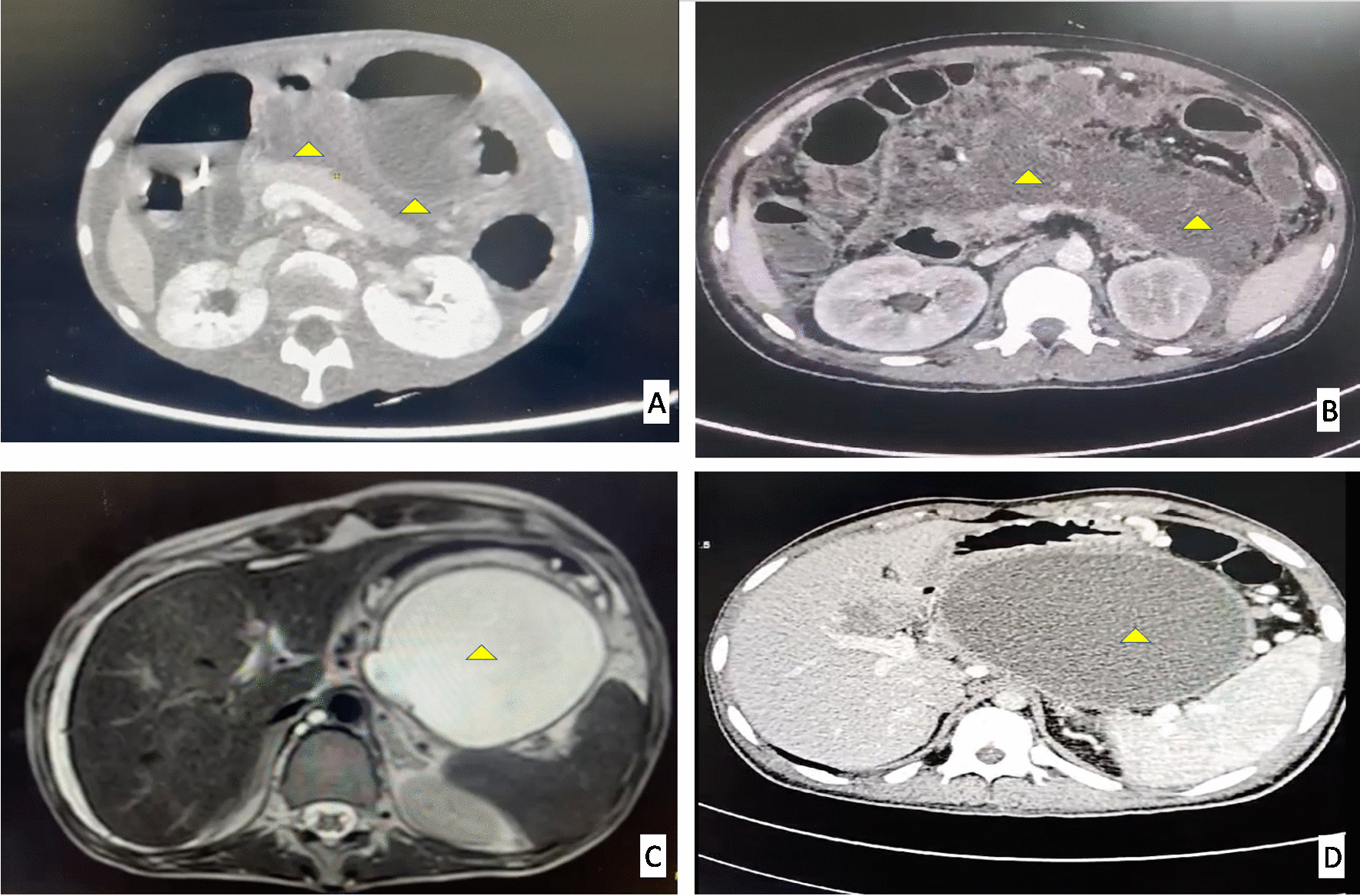 Endoscopic interventions for managing pancreatic fluid collections associated with acute pancreatitis: A state-of-the-art review (with videos)