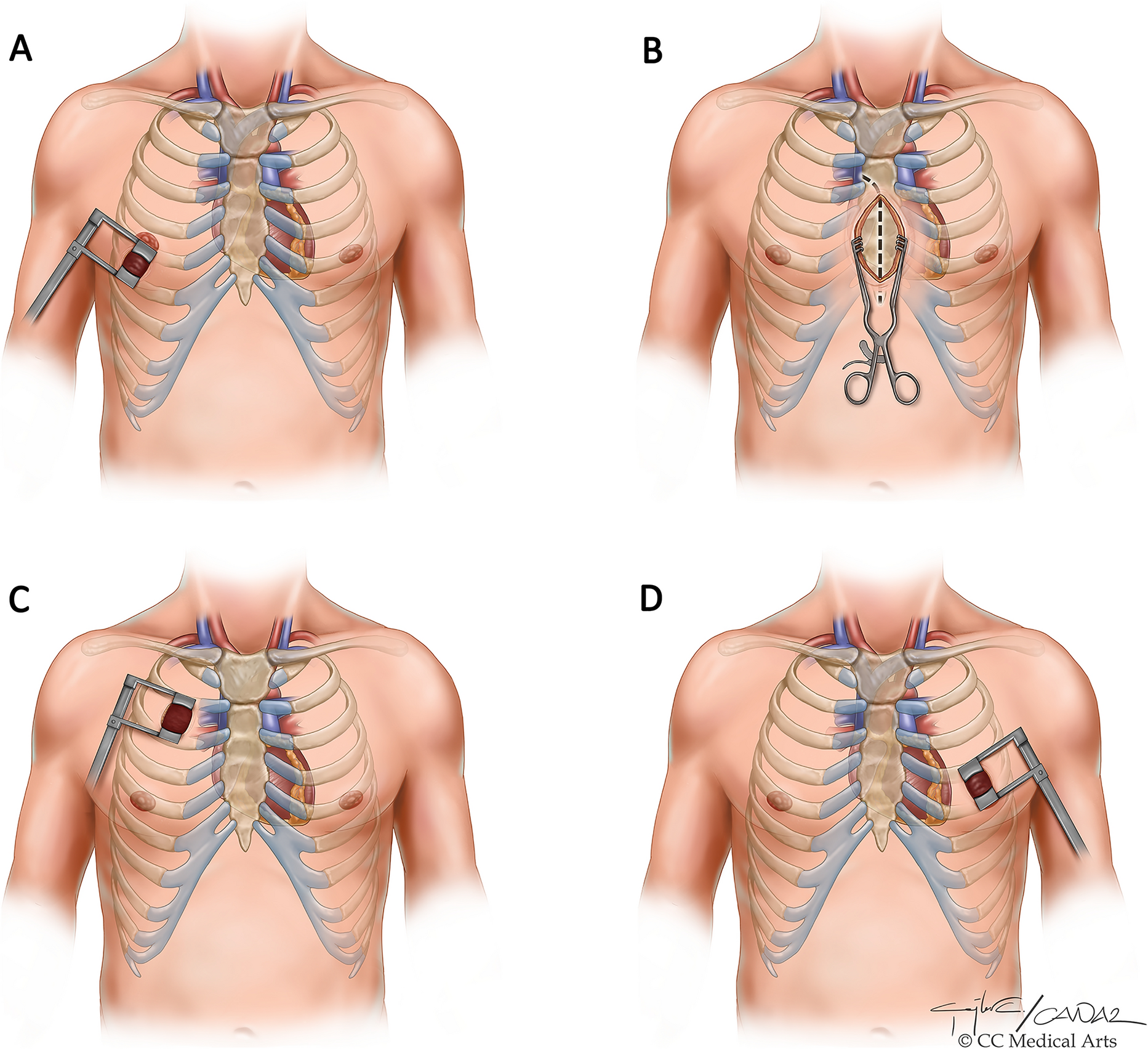 Pain Management in Minimally Invasive Cardiac Surgery: A Review of Current Clinical Evidence