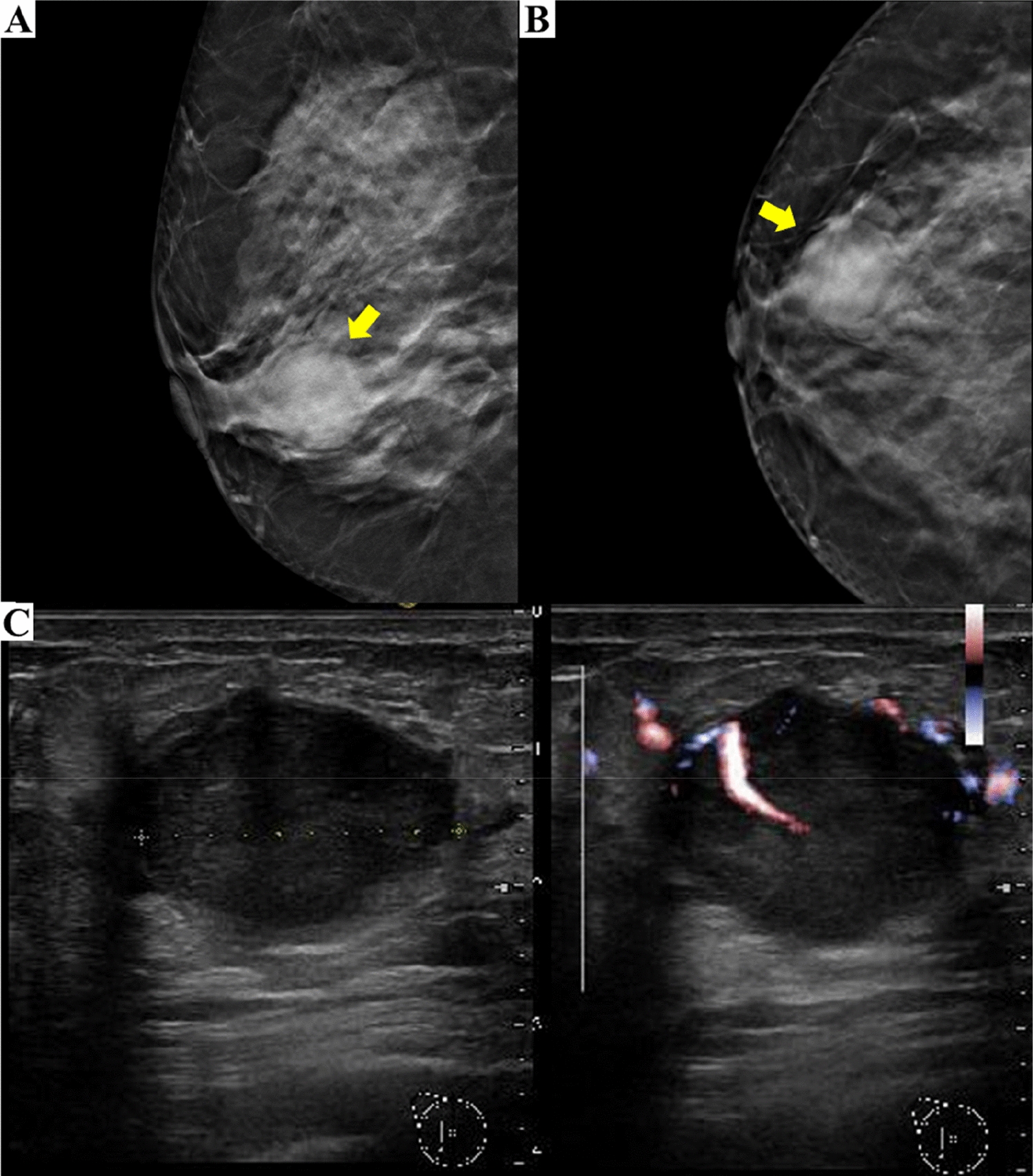 Polymorphous adenocarcinoma-like tumor of the breast: the first case report from Japan