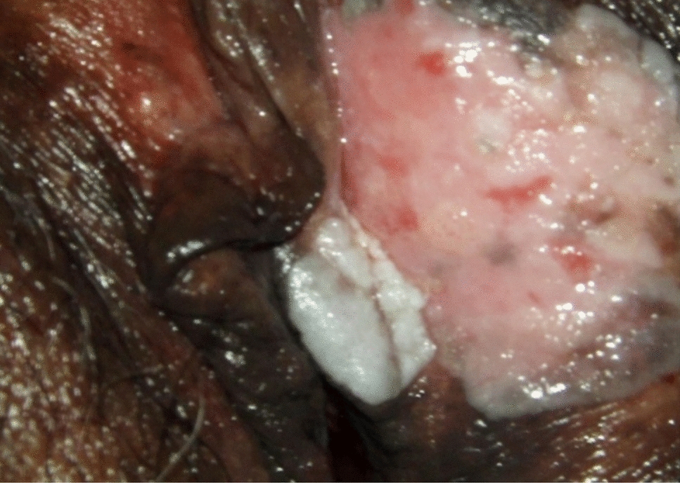 Colposcopy in the Diagnosis of Multisite HPV-Associated Rare Neoplasia: A Series of Cases