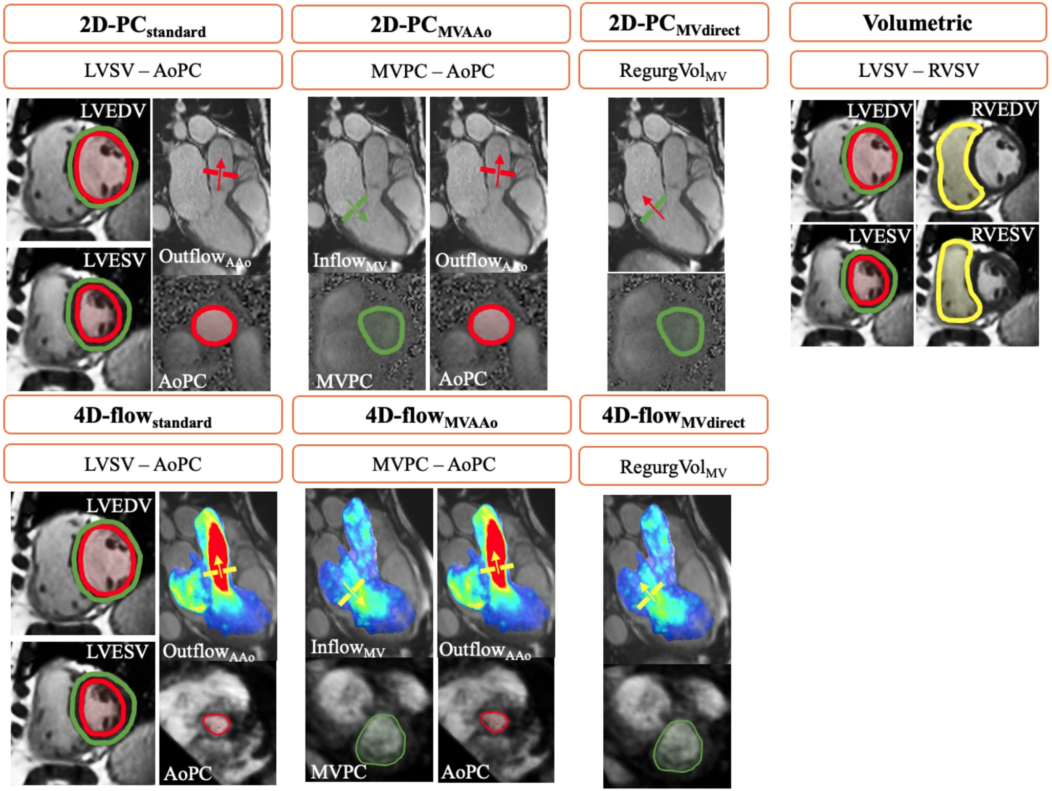 Reproducibility and reliability of flow quantification using CMR 2D-phase contrast and 4D-Flow in secondary mitral valve regurgitation