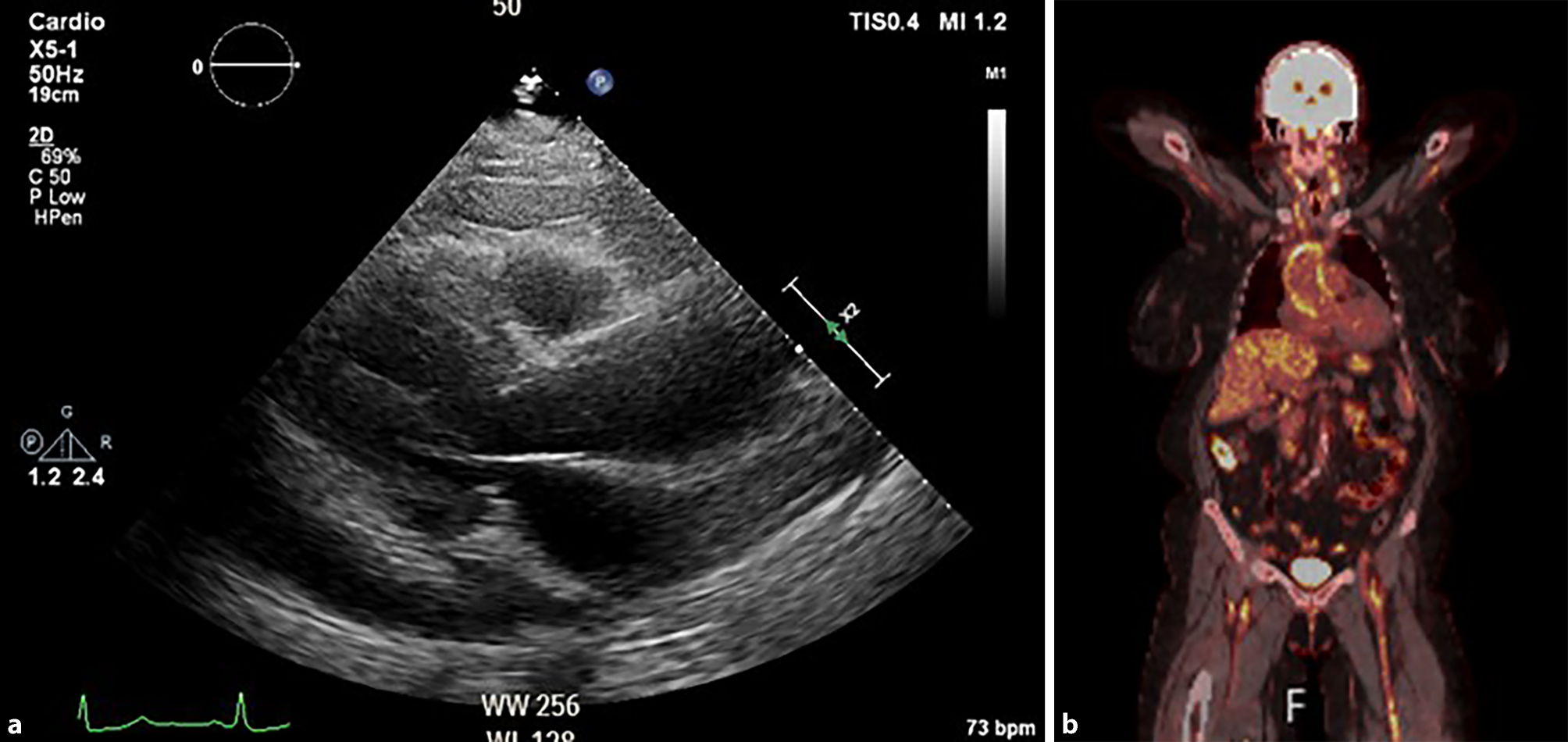 A cerebrovascular event turning pericarditis into vasculitis