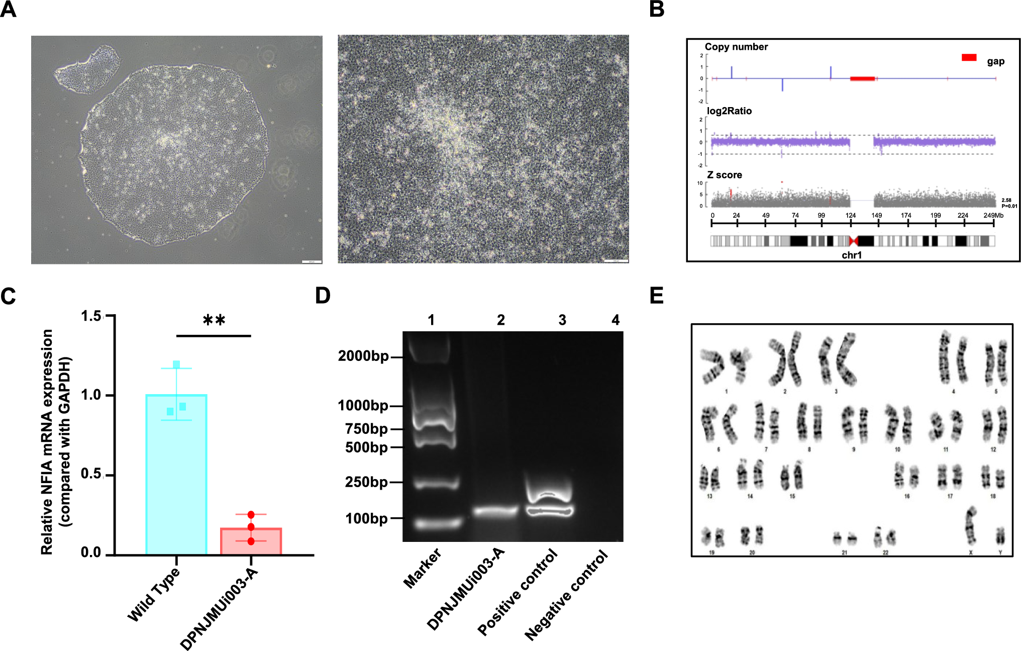 Generation of human induced pluripotent stem cell lines derived from a patient carrying an intragenic deletion in the  gene