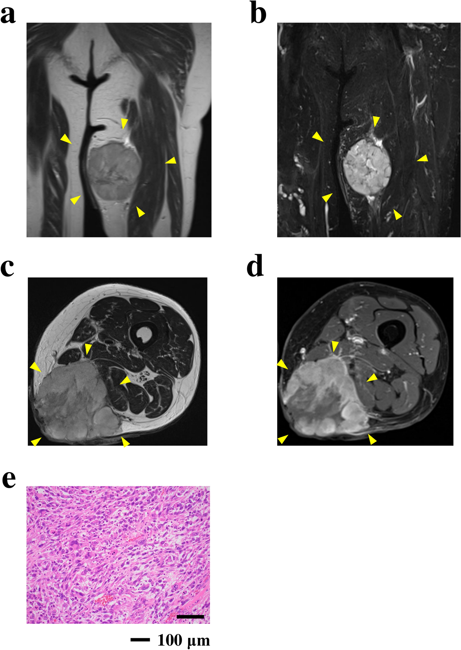 Establishment and characterization of NCC-PS2-C1: a novel cell line of high-grade pleomorphic spindle cell sarcoma, most consistent with myxofibrosarcoma