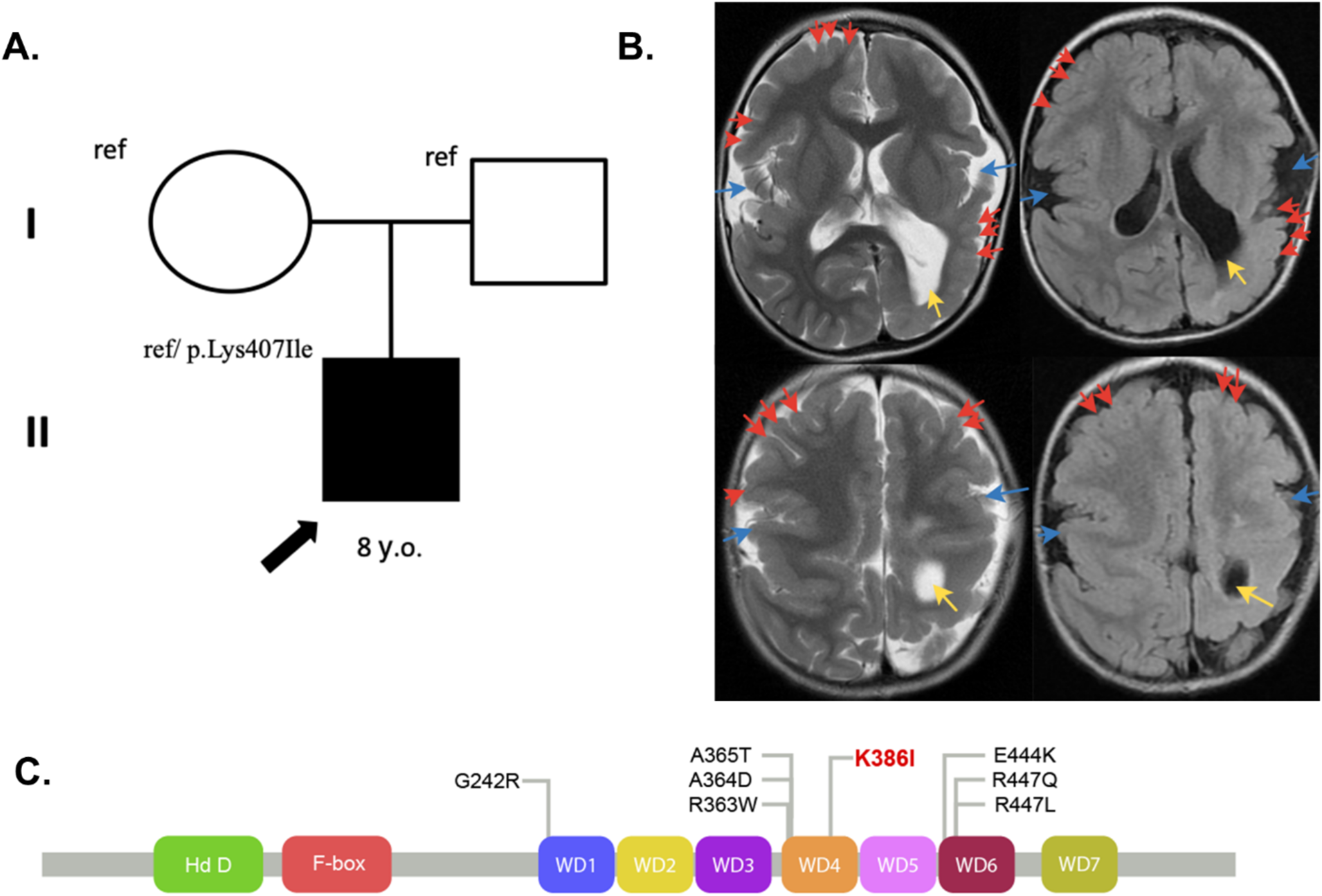 A novel  variant in a patient with neurodevelopmental, jaw, eye, and digital syndrome