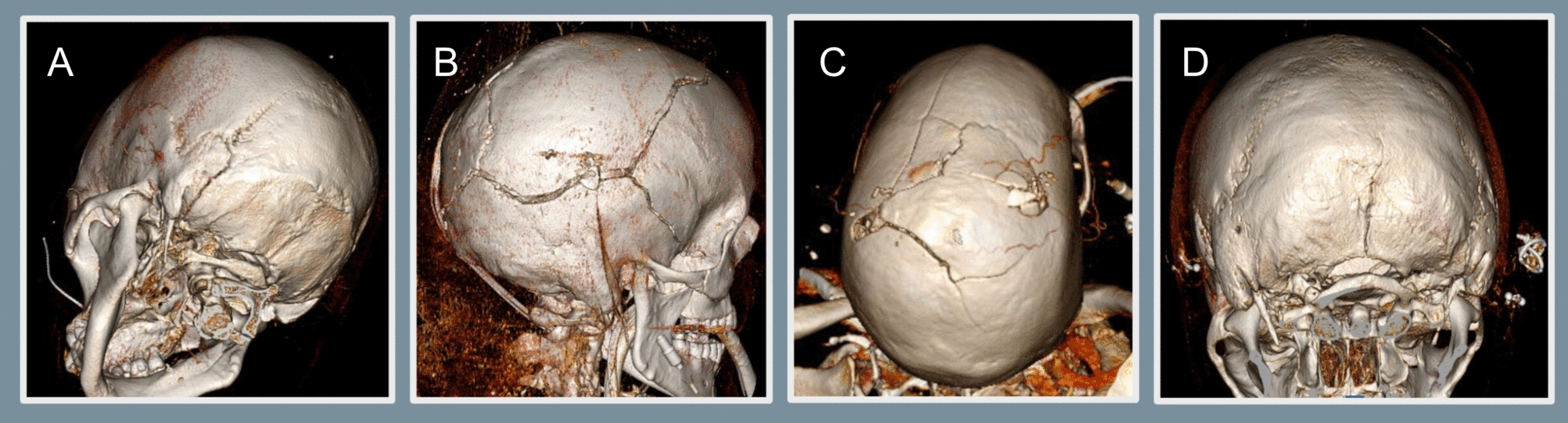 Traumatic Venous Sinus Thrombosis: Patient and Practice Patterns at a Major Trauma Center