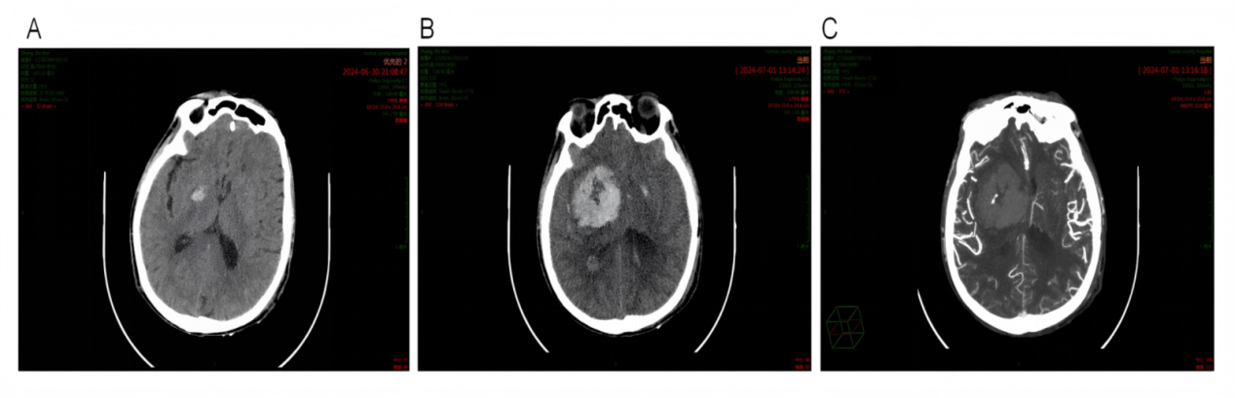 Prediction of early hematoma enlargement in hypertensive intracerebral hemorrhage using CT and CTA imaging features