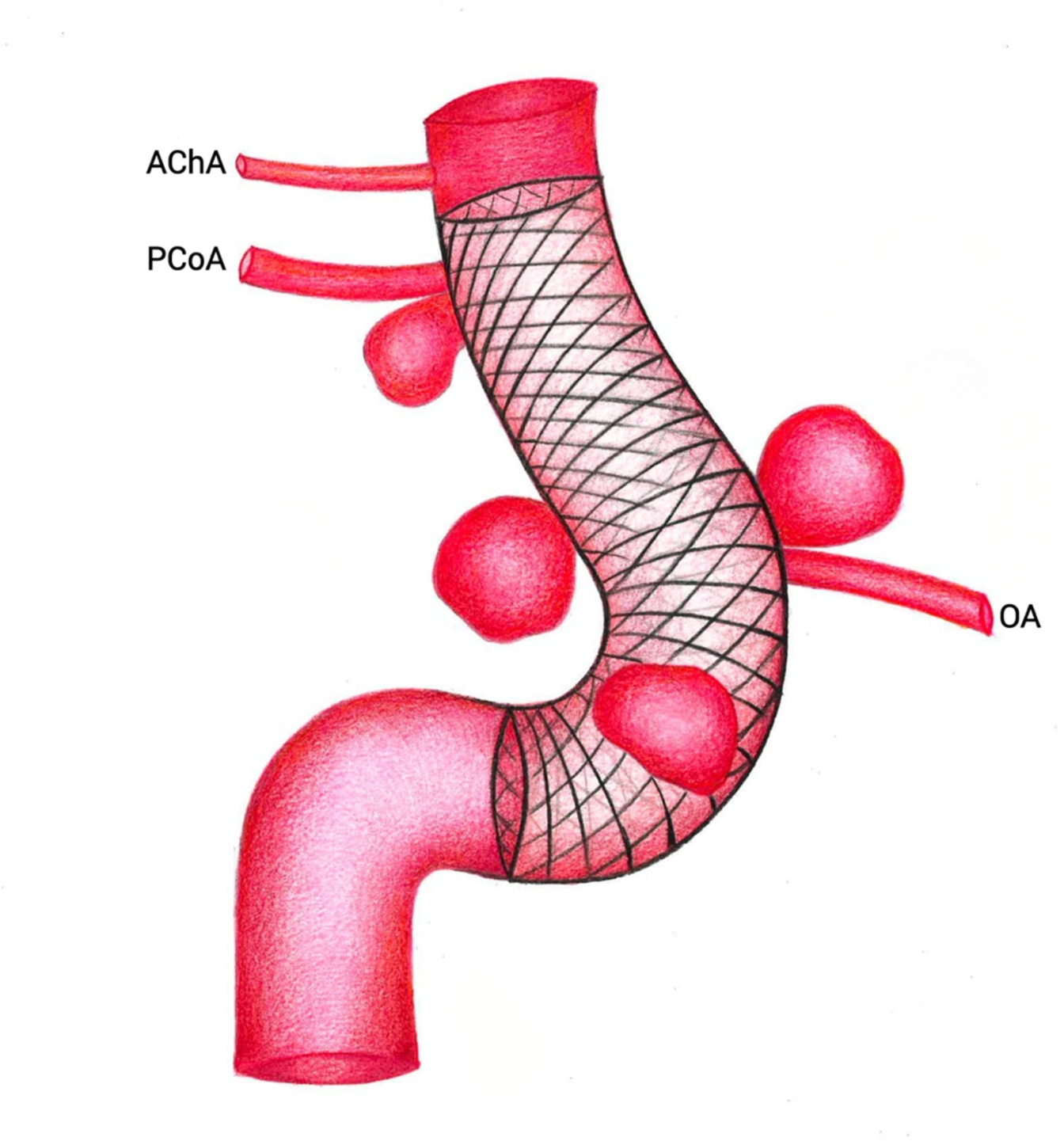 Comparative analysis of optical coherence tomography angiography findings before and after flow-diverting stent treatment covering the ophthalmic artery origin in the management of paraclinoid aneurysms
