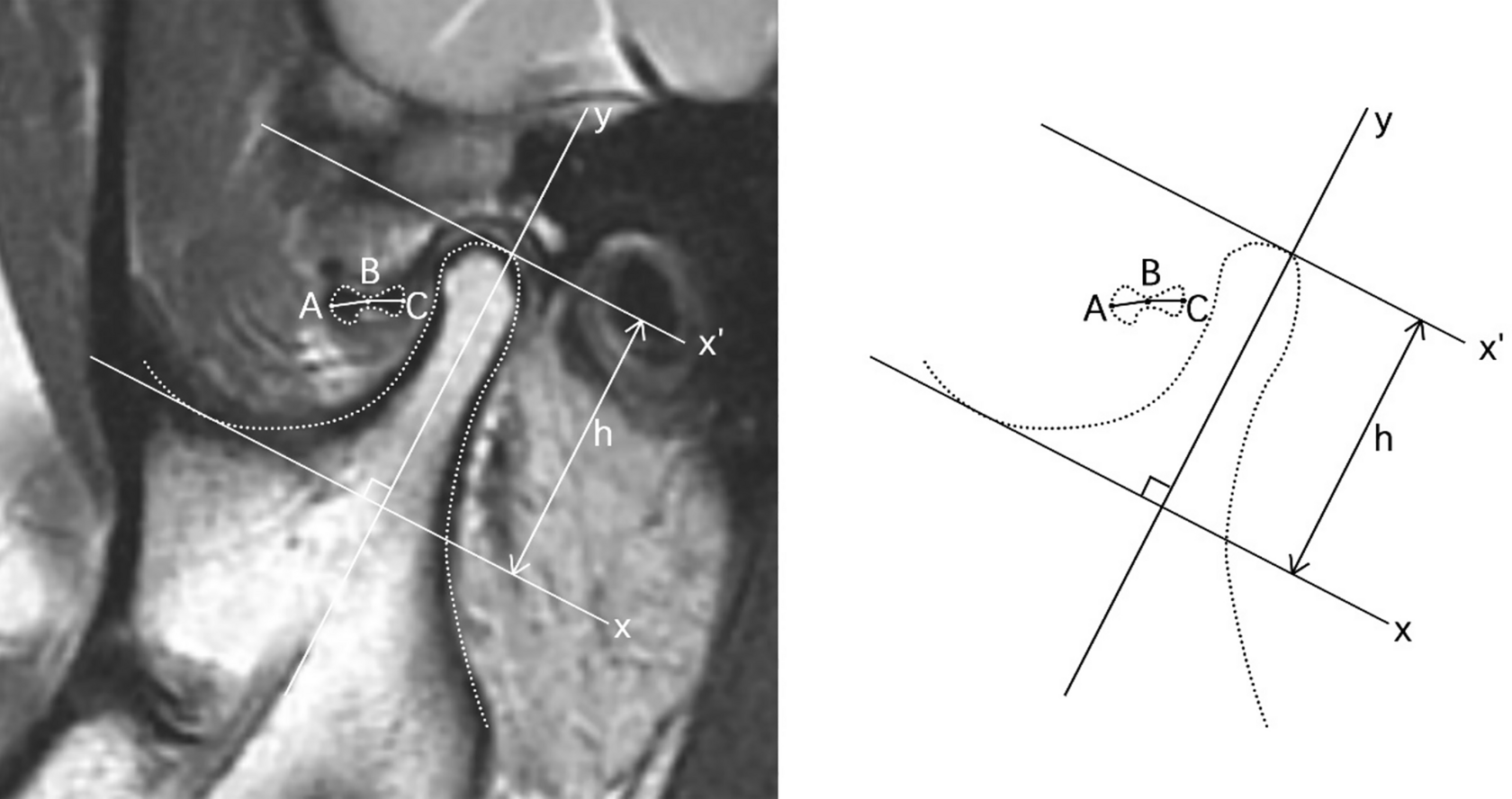 Efficacy of two different treatment modalities for juvenile patients with anterior disk displacement without reduction: an 18-month follow-up study