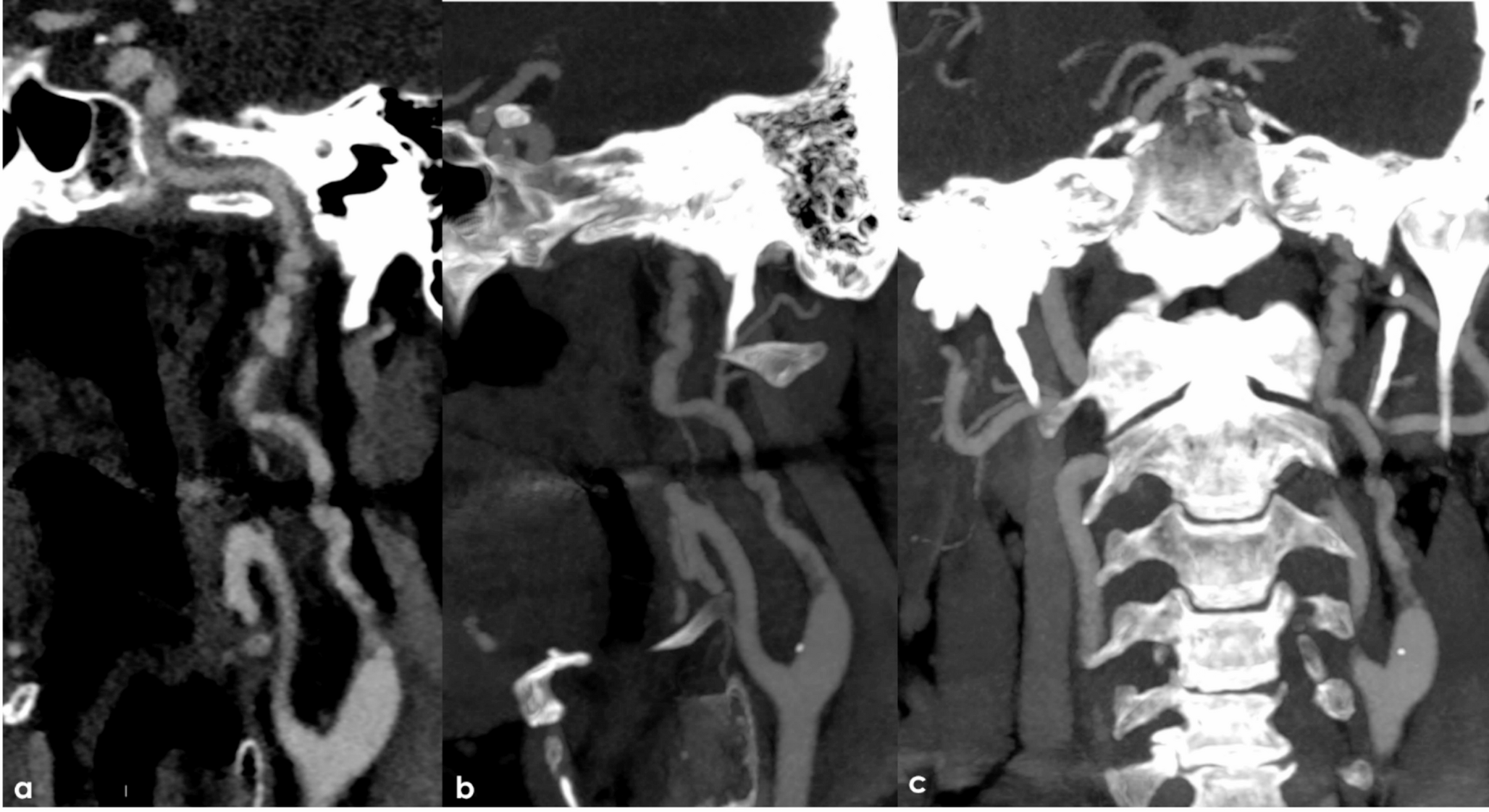 Multichannel internal carotid artery: congenital or acquired pattern?