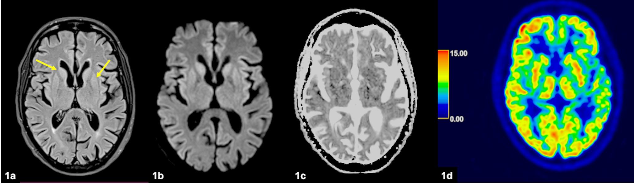 Rapidly progressive dementia in tacrolimus neurotoxicity: rare but reversible