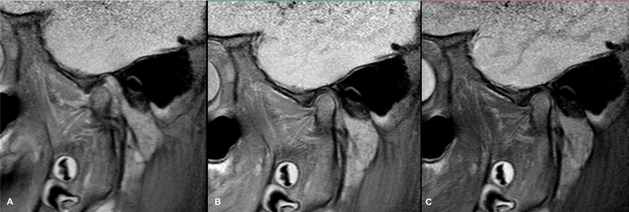 Improving TMJ MRI diagnostics in juvenile idiopathic arthritis: a comparative evaluation of image enhancement filters