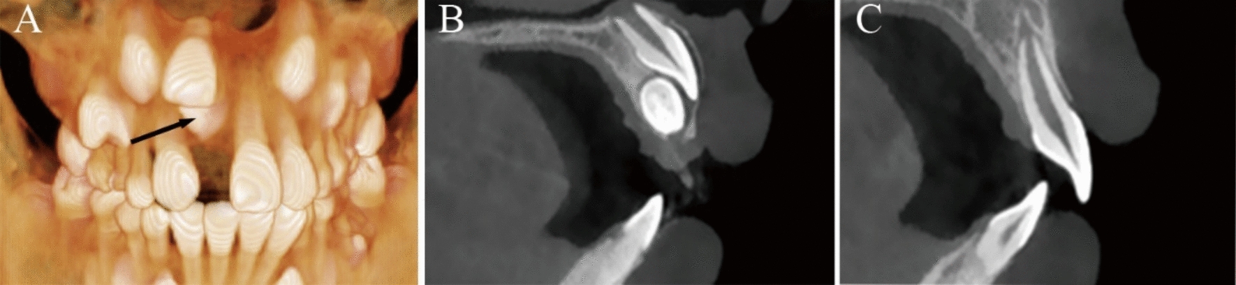 Association between 3D characteristics of single unilaterally impacted mesiodens and root development of adjacent maxillary central incisors: a retrospective study with cone-beam computed tomography