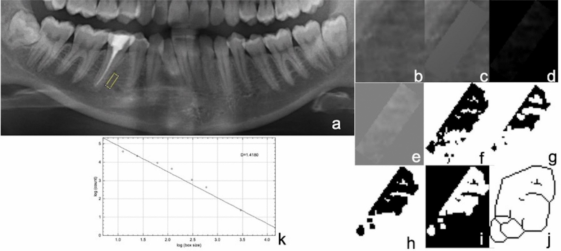 Evaluation of the long-term structural change caused by root canal treatment in the bone around the tooth by fractal analysis