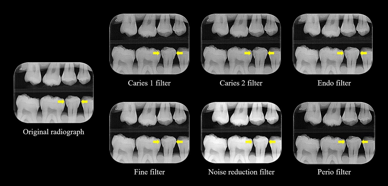 Influence of enhancement filters on the diagnosis of proximal caries lesions in radiographs obtained with a handheld X-ray unit