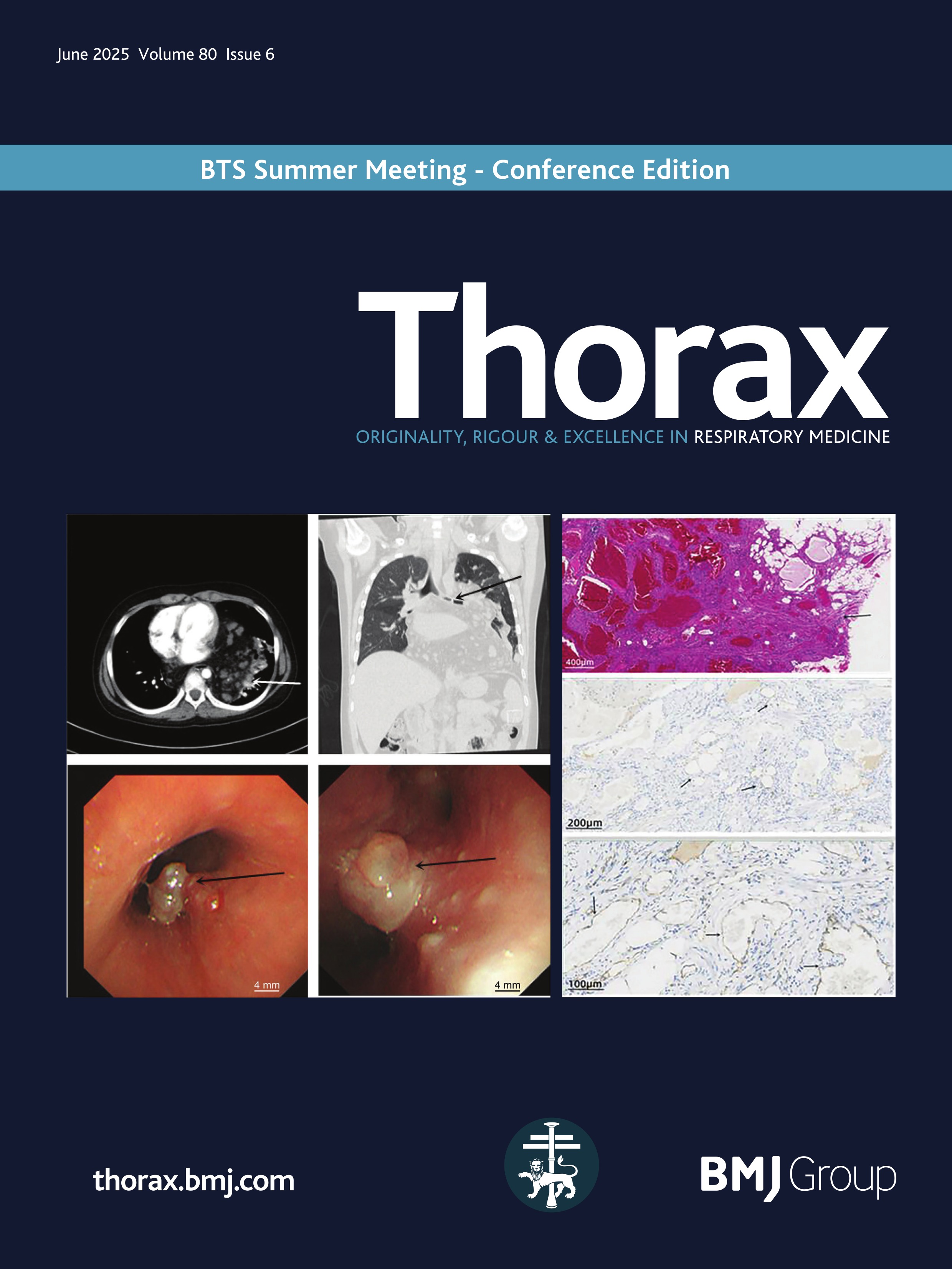 Clinical presentation and prognosis of acute symptomatic pulmonary embolism in patients with concomitant upper-extremity versus lower-extremity deep vein thrombosis
