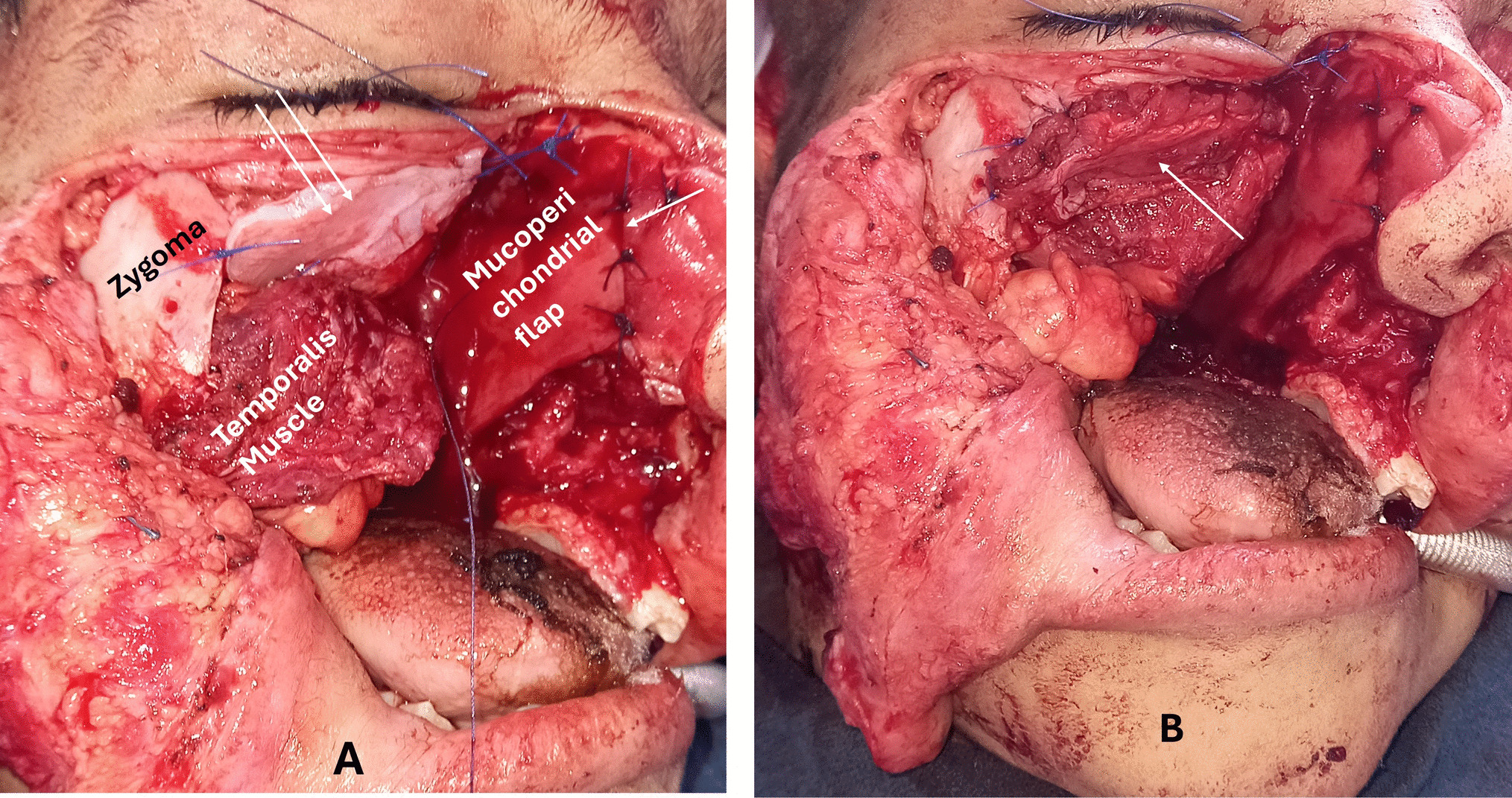 Nasoseptal Cartilage for Post Maxillectomy Orbital Support: Technical Report