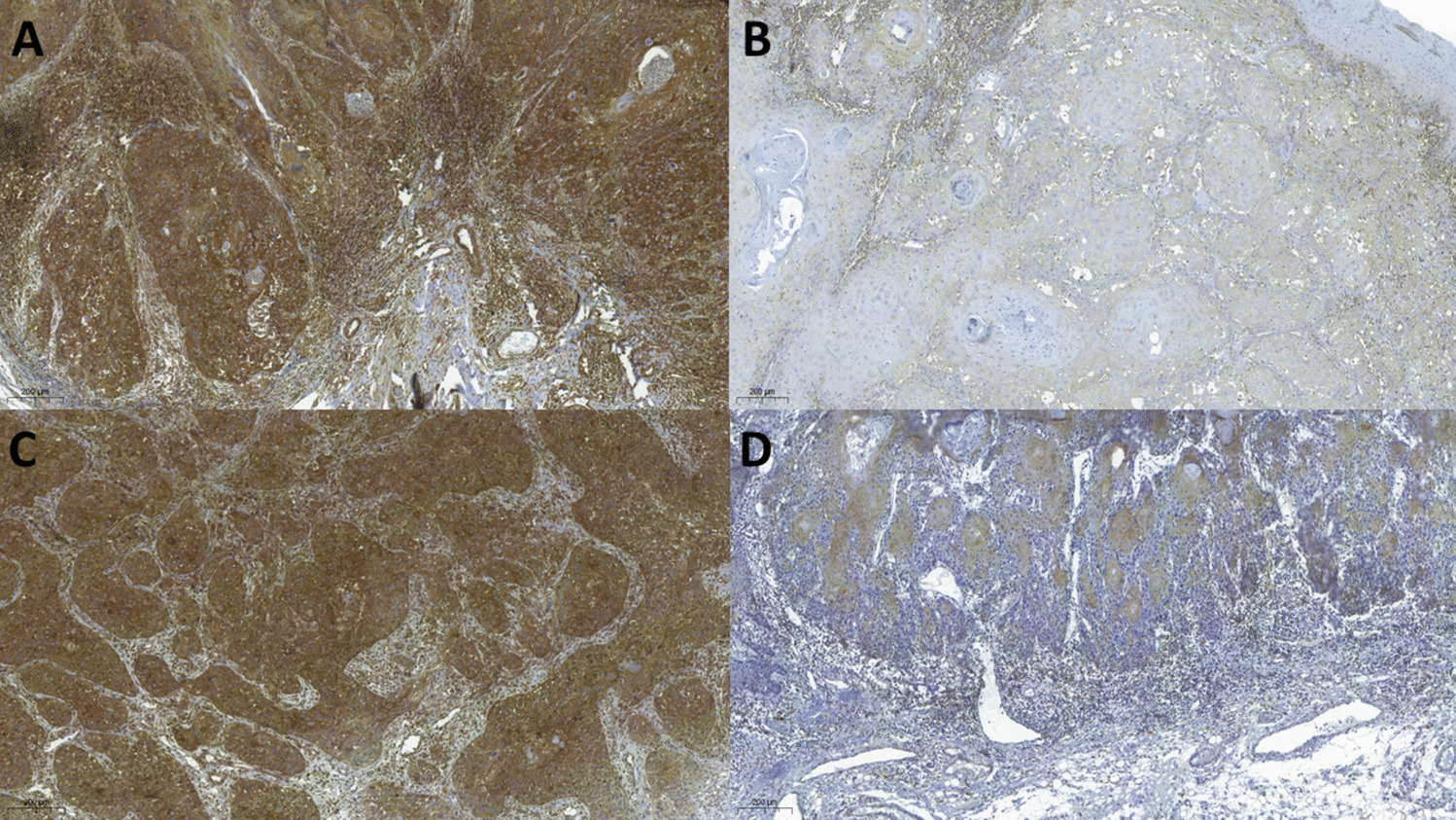 Evaluation of the Presence of Th2 Response Through GATA-3 and IL-4 Expression in Oral Tongue and Lower Lip Squamous Cell Carcinomas