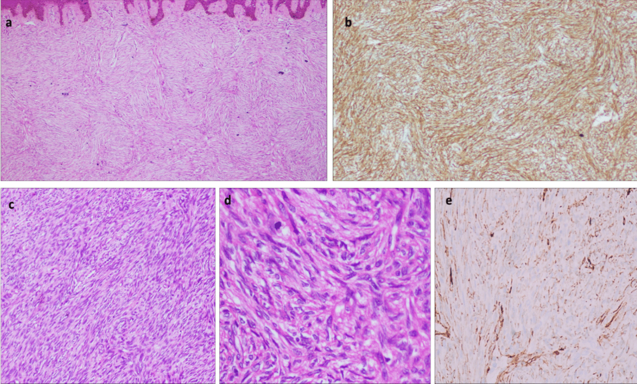 Dermatofibrosarcoma Protuberans: A Diagnostic and Management Conundrum—A Retrospective Study from a Tertiary Care Center in South India