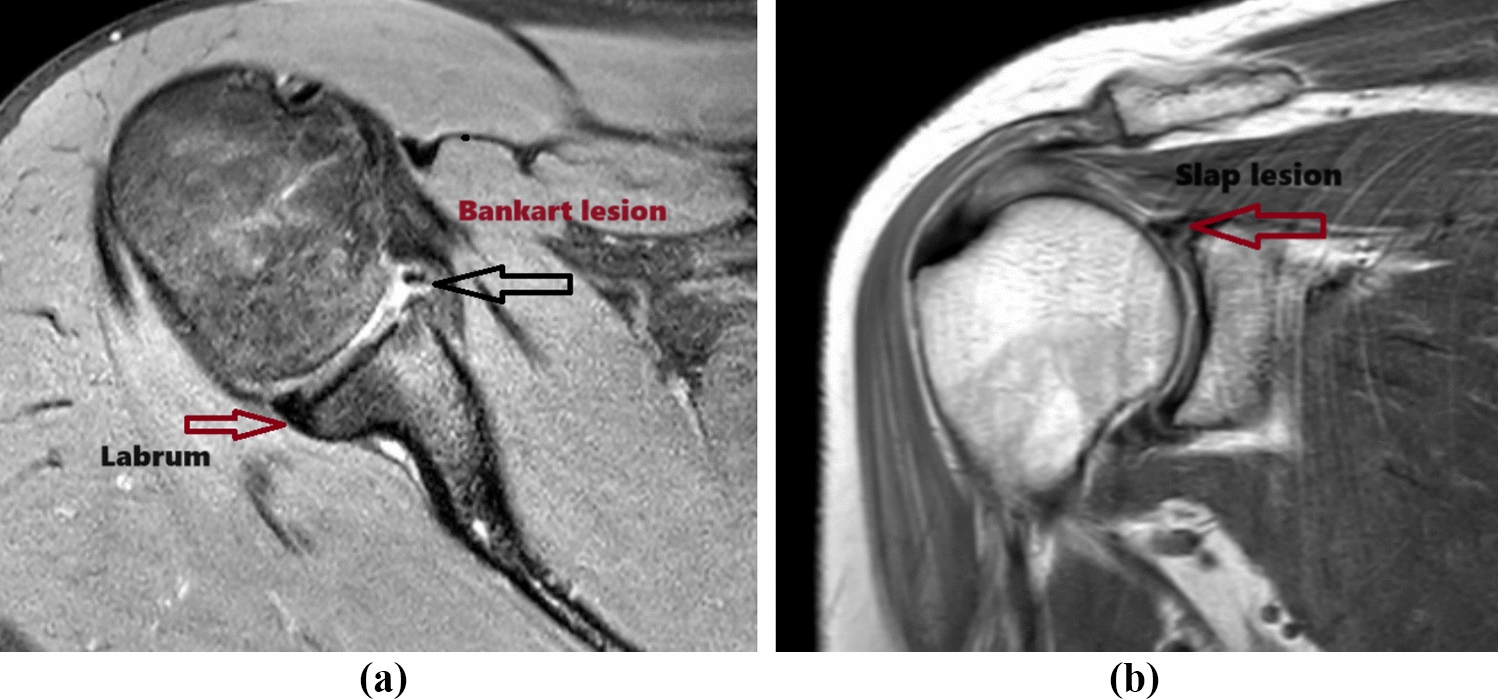 MobileTurkerNeXt: investigating the detection of Bankart and SLAP lesions using magnetic resonance images