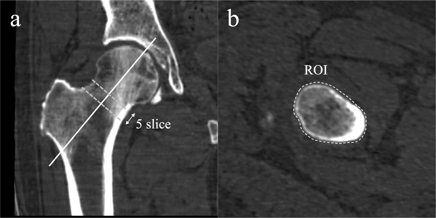 Evaluation of femoral bone mineral density in patients with hip osteoarthritis using material density image in dual-energy computed tomography